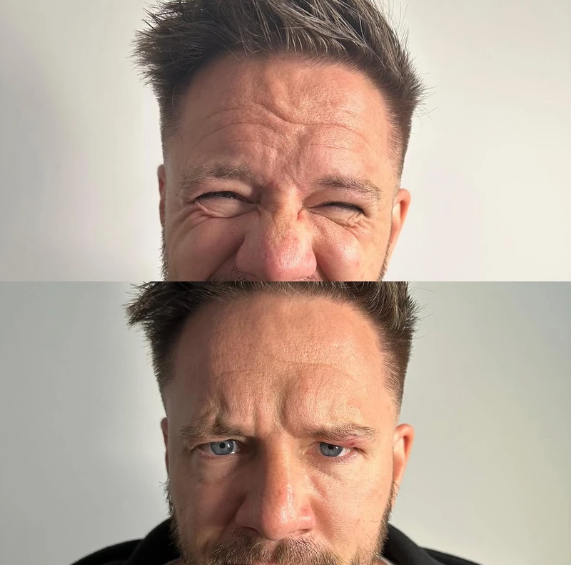 Injectable Treatment — Real Client Result - Before & After