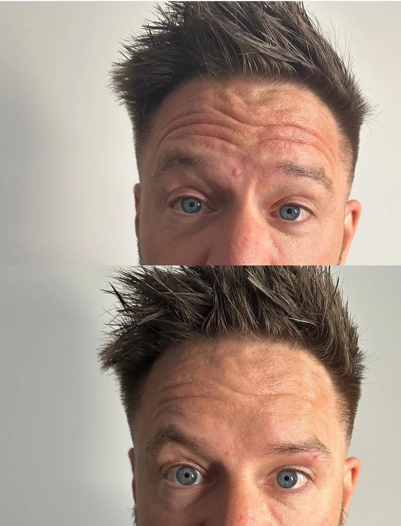 Injectable Treatment — Real Client Result - Before & After