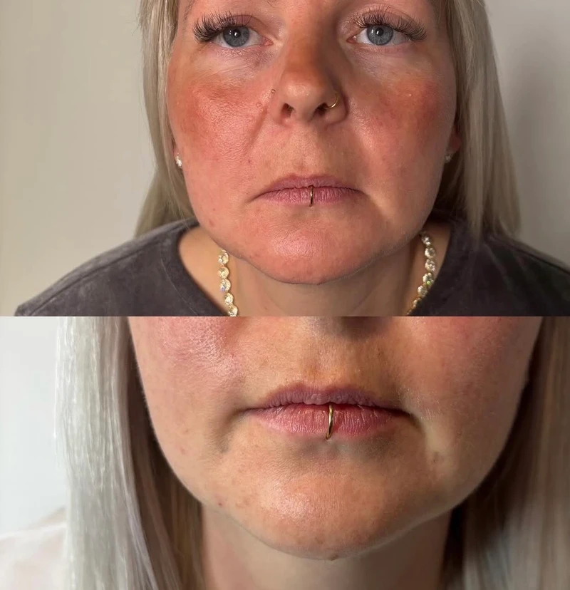 Injectable Treatment — Real Client Result - Before & After