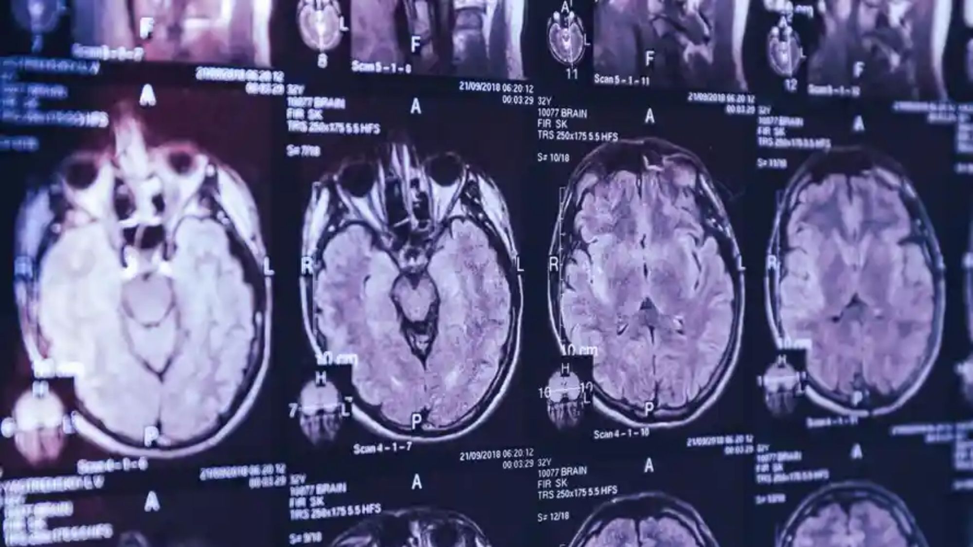 Canadian doctors baffled by mysterious rare brain disease