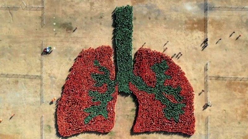 PH Sets Record for Largest Human Lung Formation