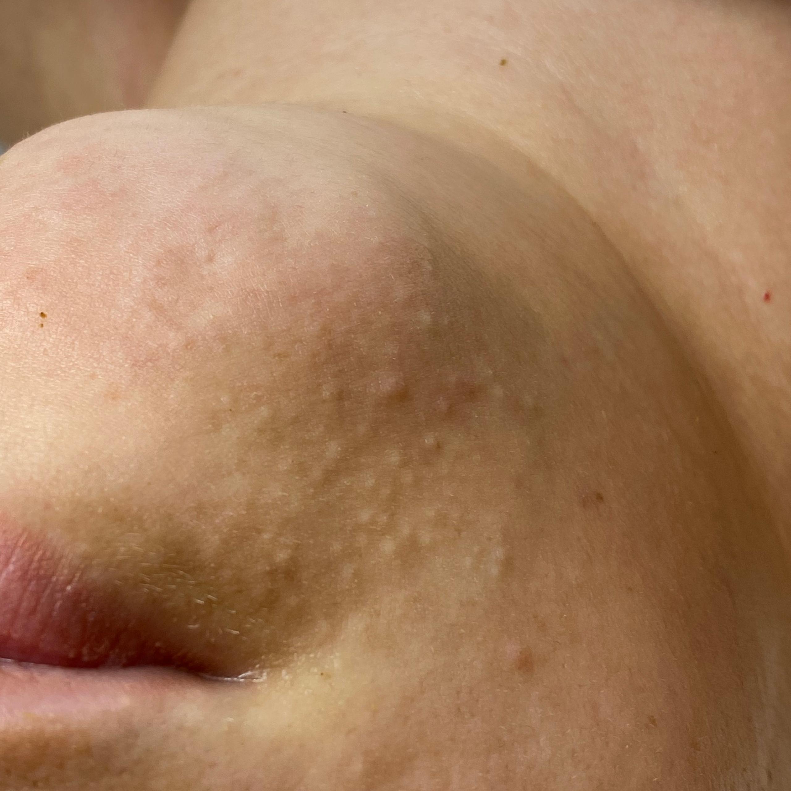 Close-up of skin on the chin and lower face with numerous small white bumps