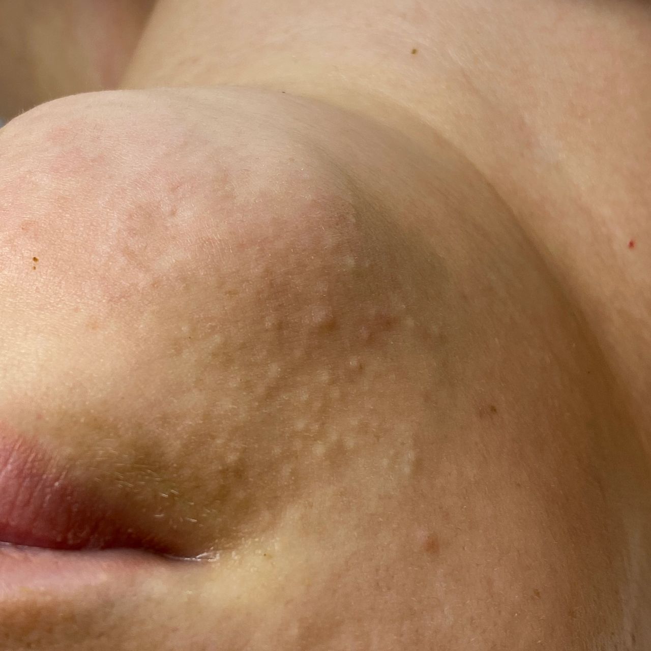 Close-up of skin on the chin and lower face with numerous small white bumps