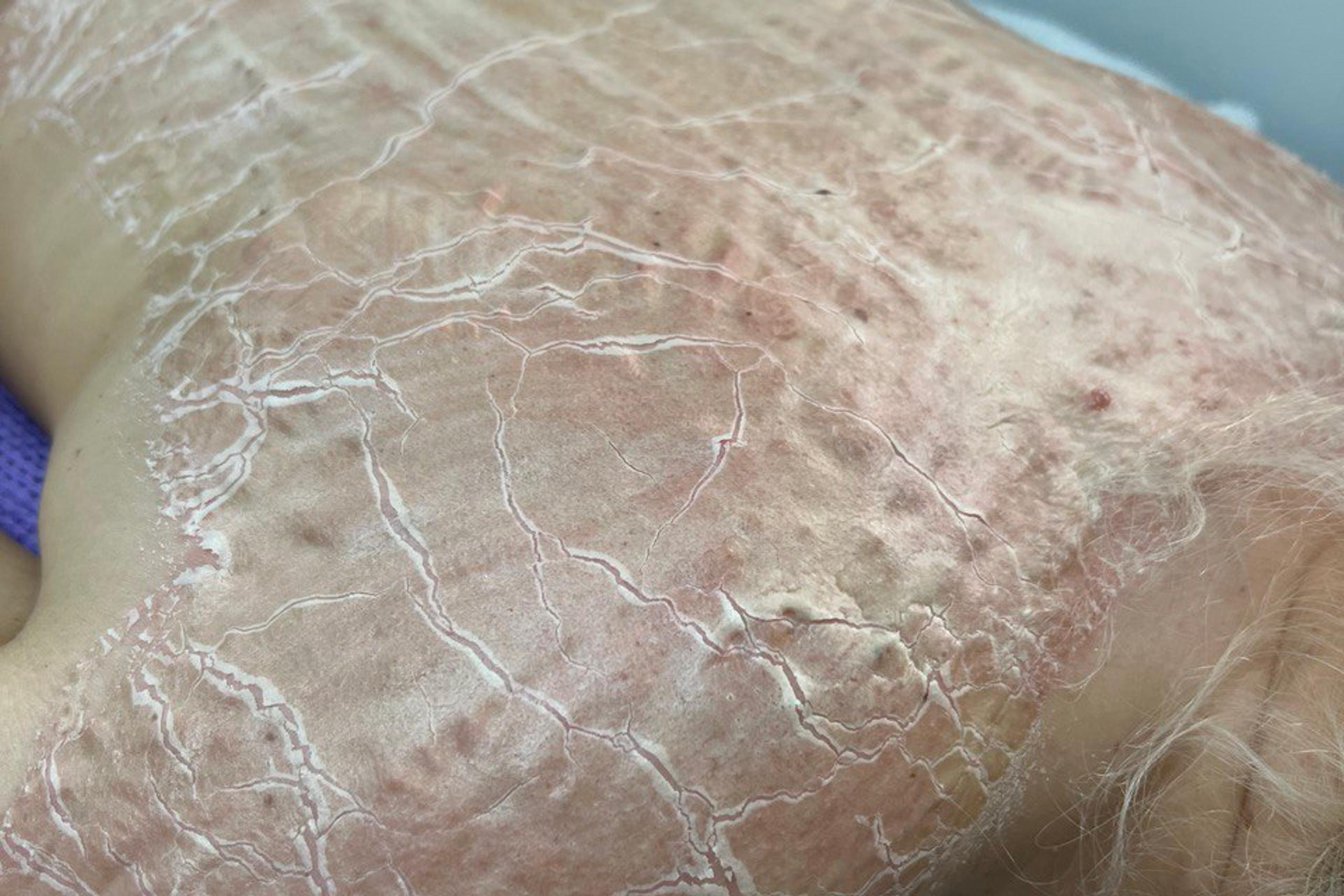A person's back and shoulder covered in severely cracked, peeling, and red skin.