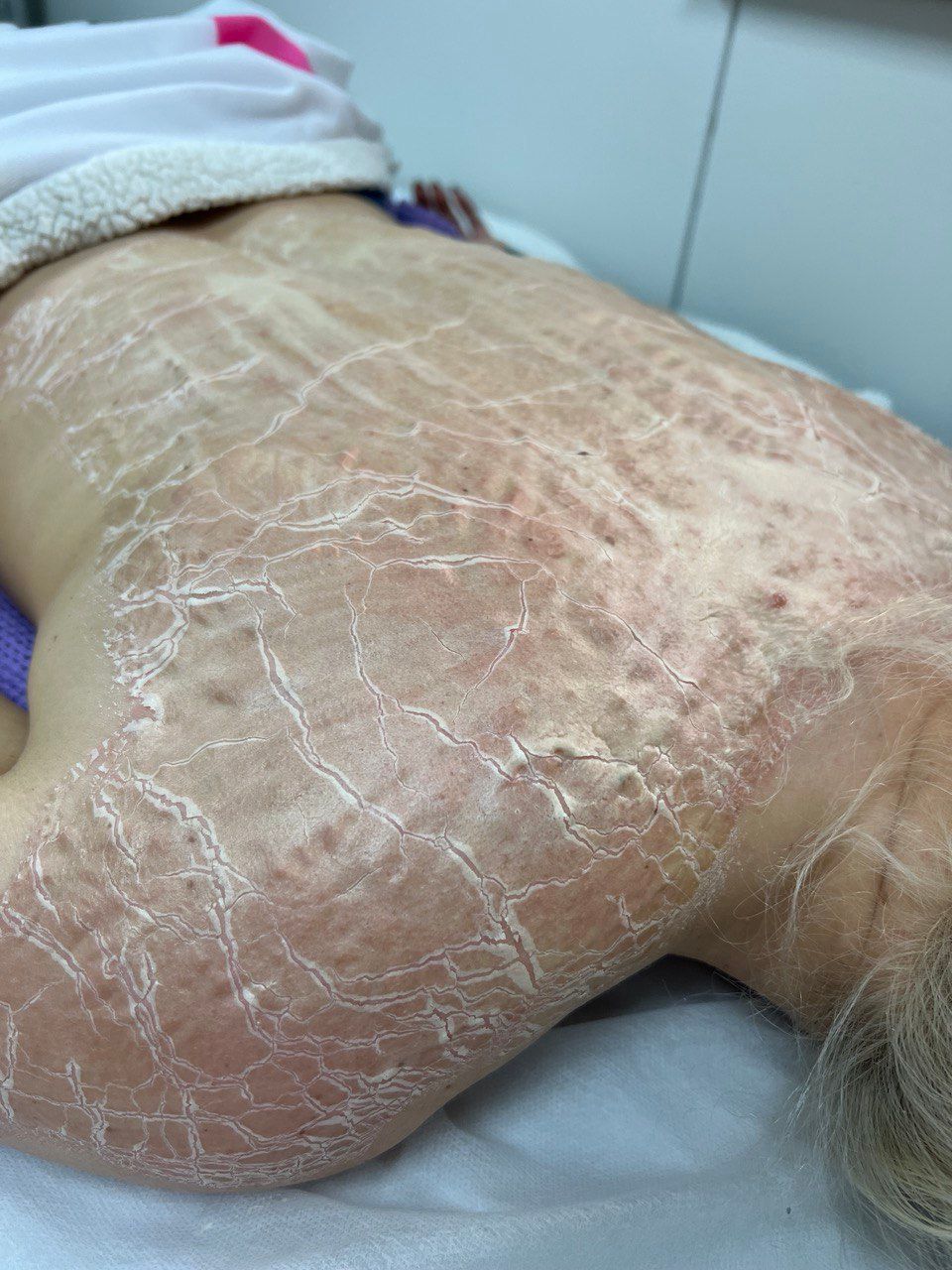 A person's back and shoulder covered in severely dry, red, and cracked mask.
