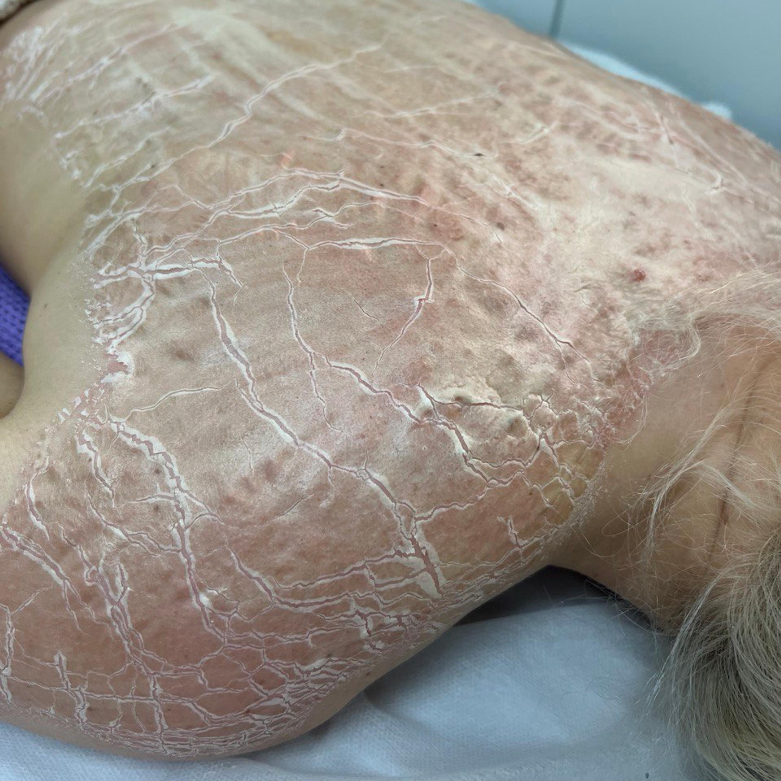 A person's back and shoulder covered in severely dry, red, and cracked mask.
