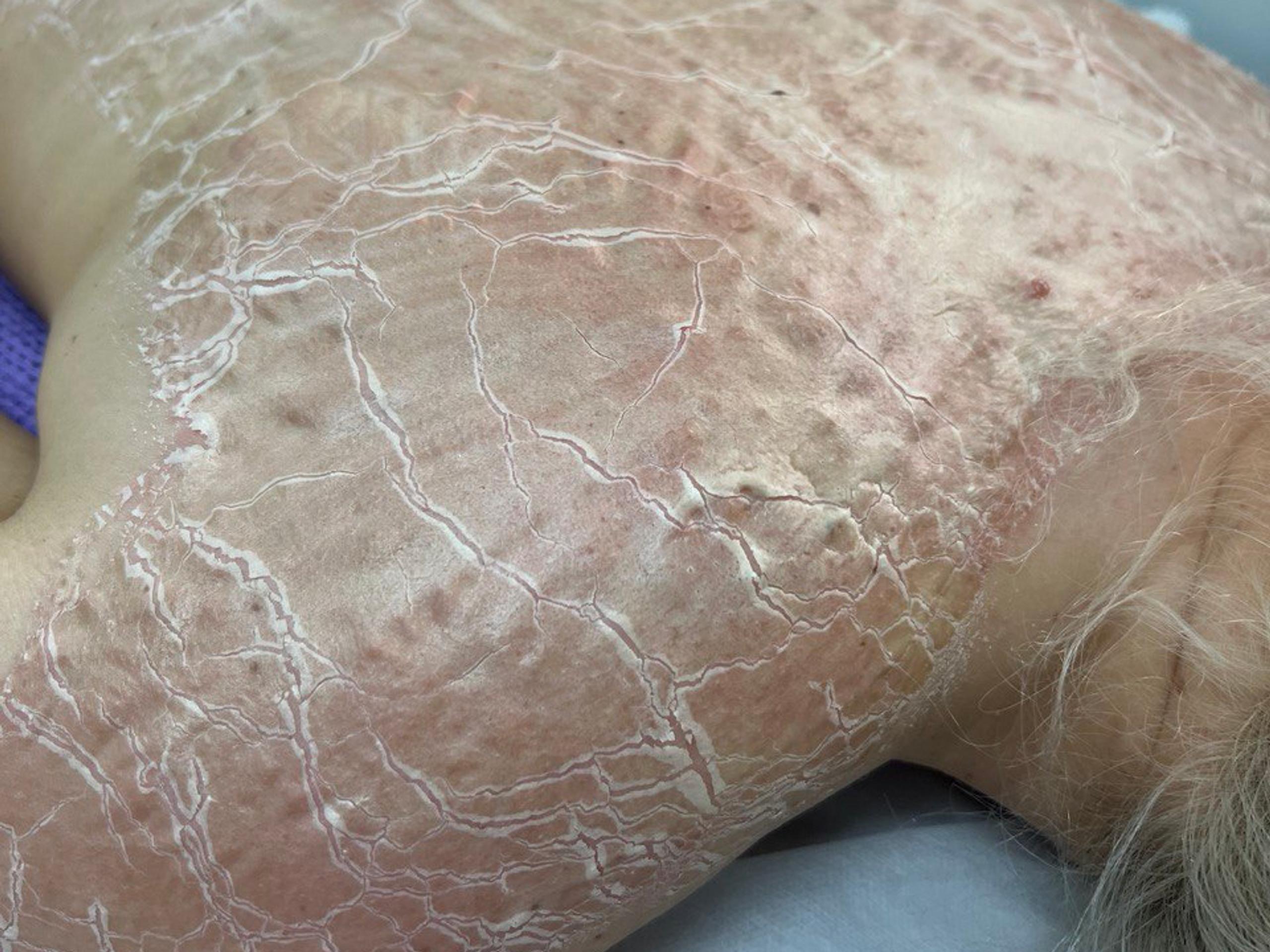 A person's back and shoulder covered in severely dry, red, and cracked mask.