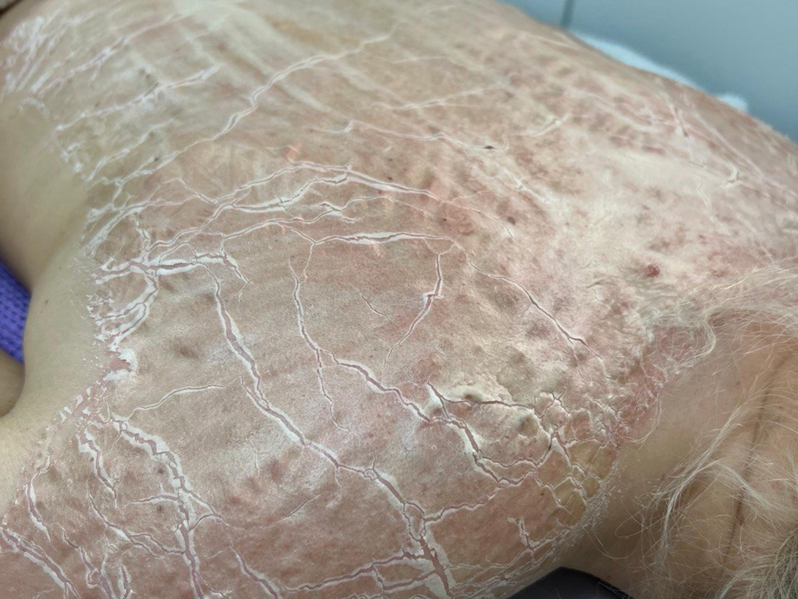 Upper back and shoulder of a person with dry, cracked mask