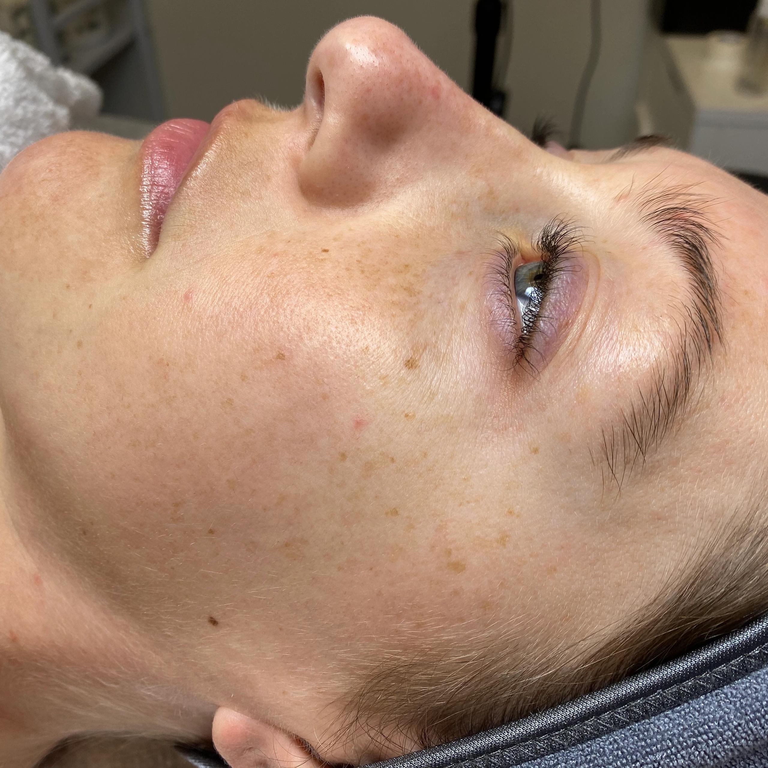 Side profile close-up of a person's face with freckled skin, a partially open eye, and pink lips