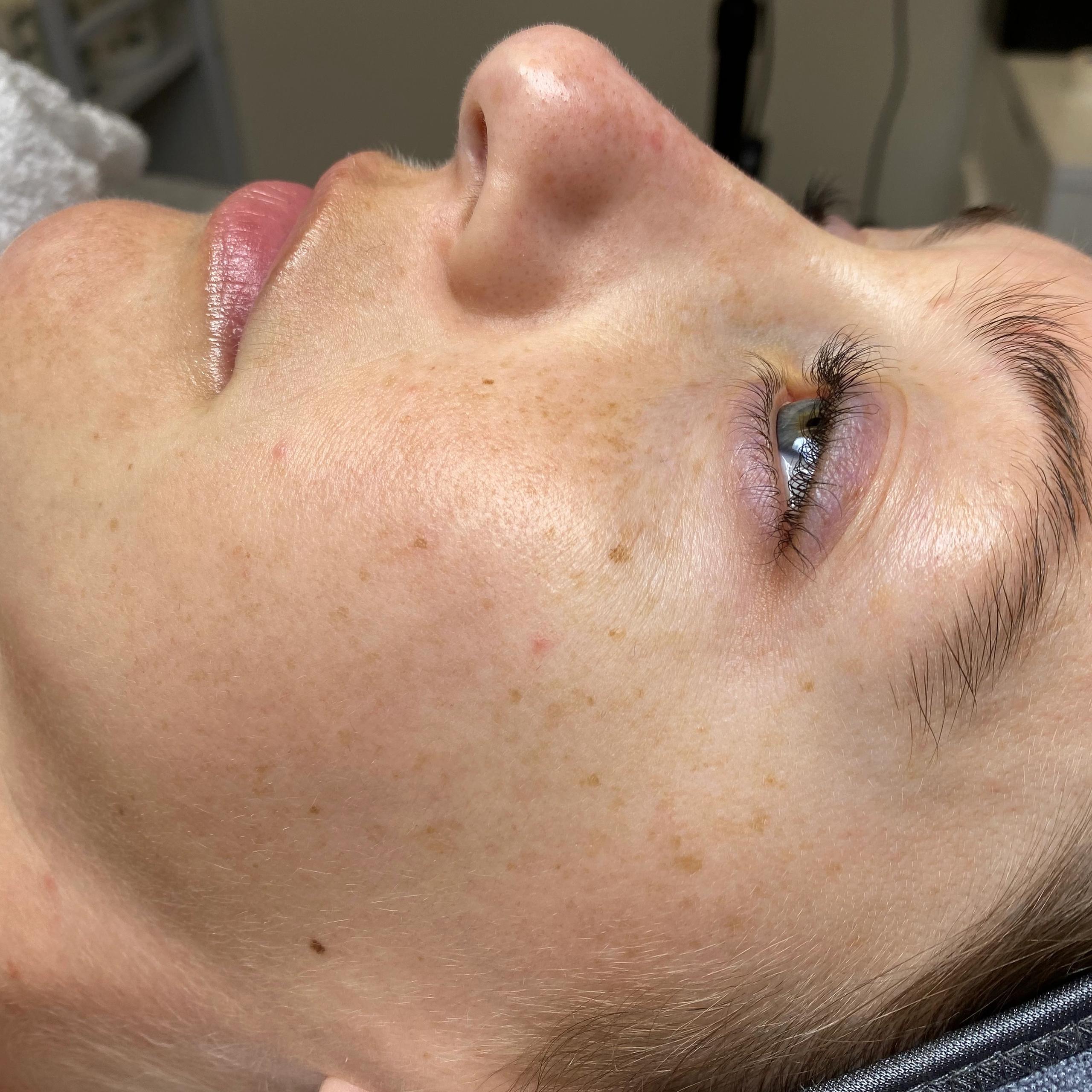 Side profile close-up of a person's face with freckled skin, a partially open eye, and pink lips