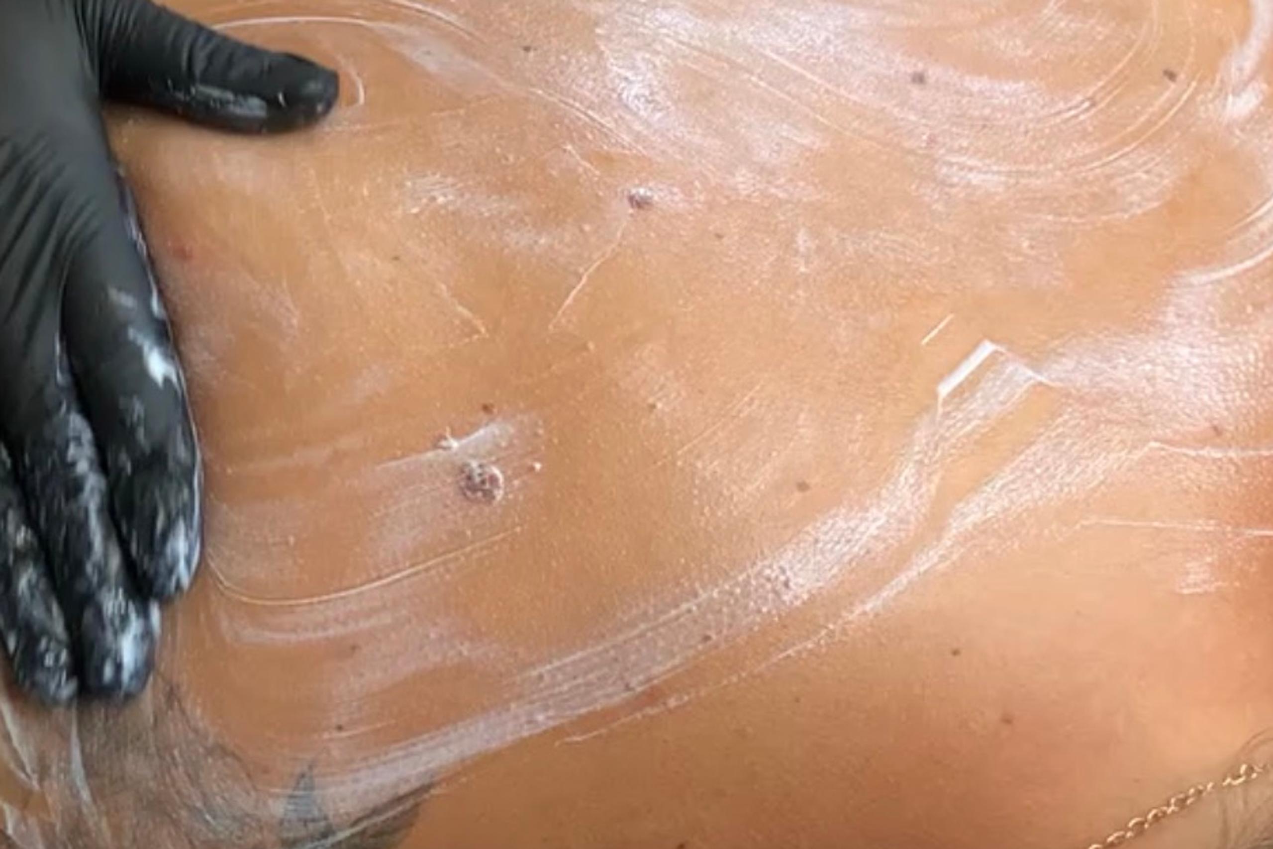 Gloved hand applying white cream to a person's back.