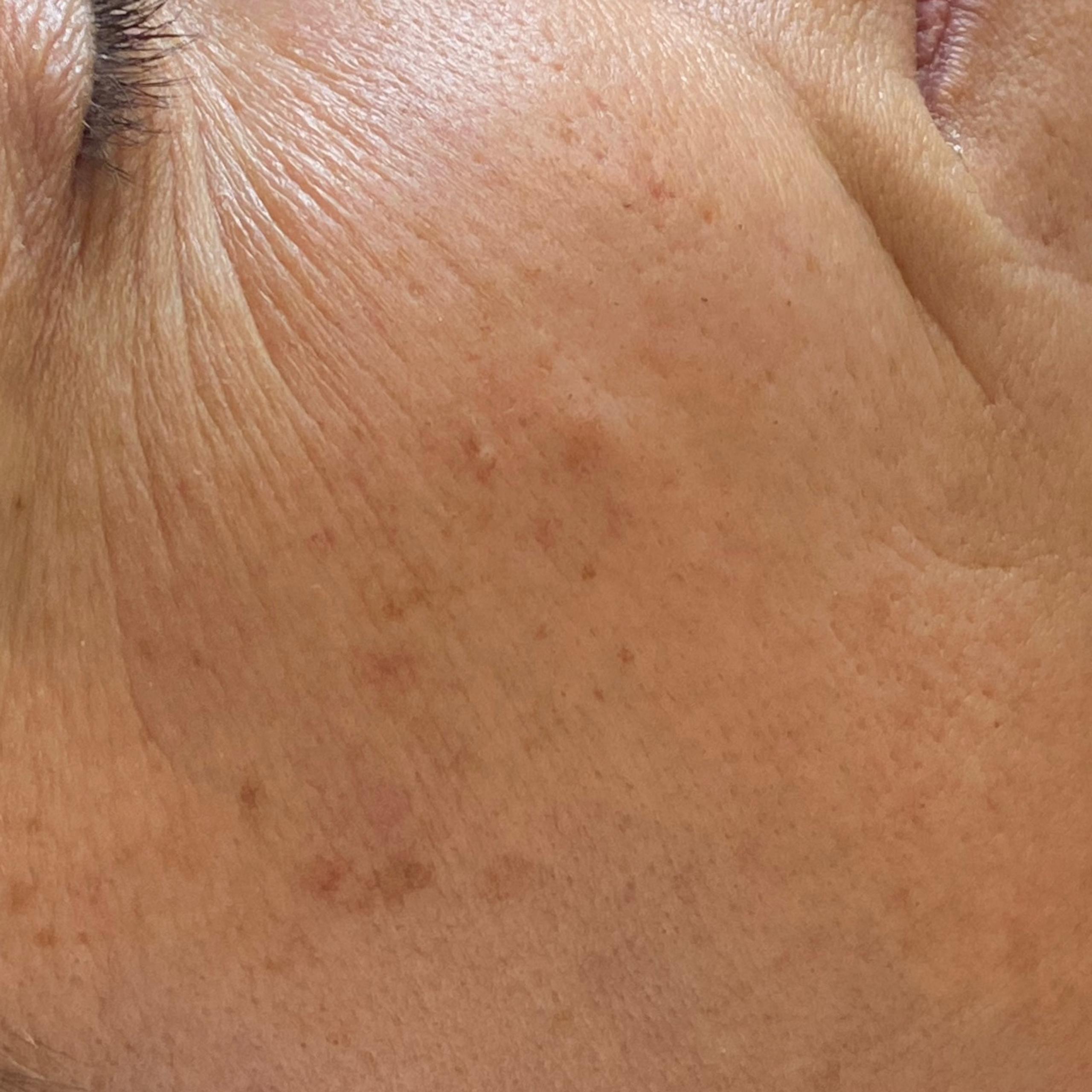Close-up of a person's face, showing red and textured skin right after the treatment