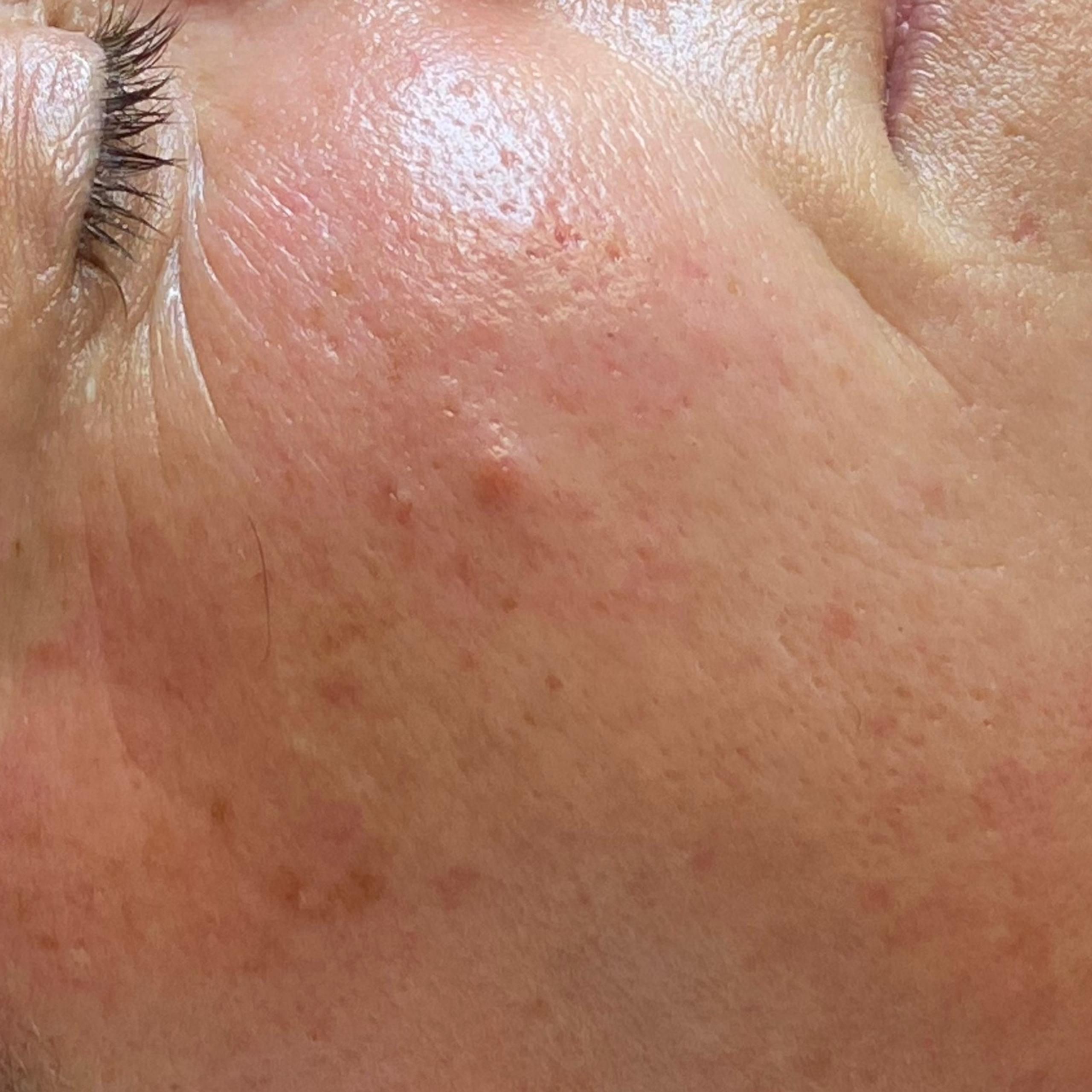 Close-up of a person's face, showing red and textured skin right after the treatment