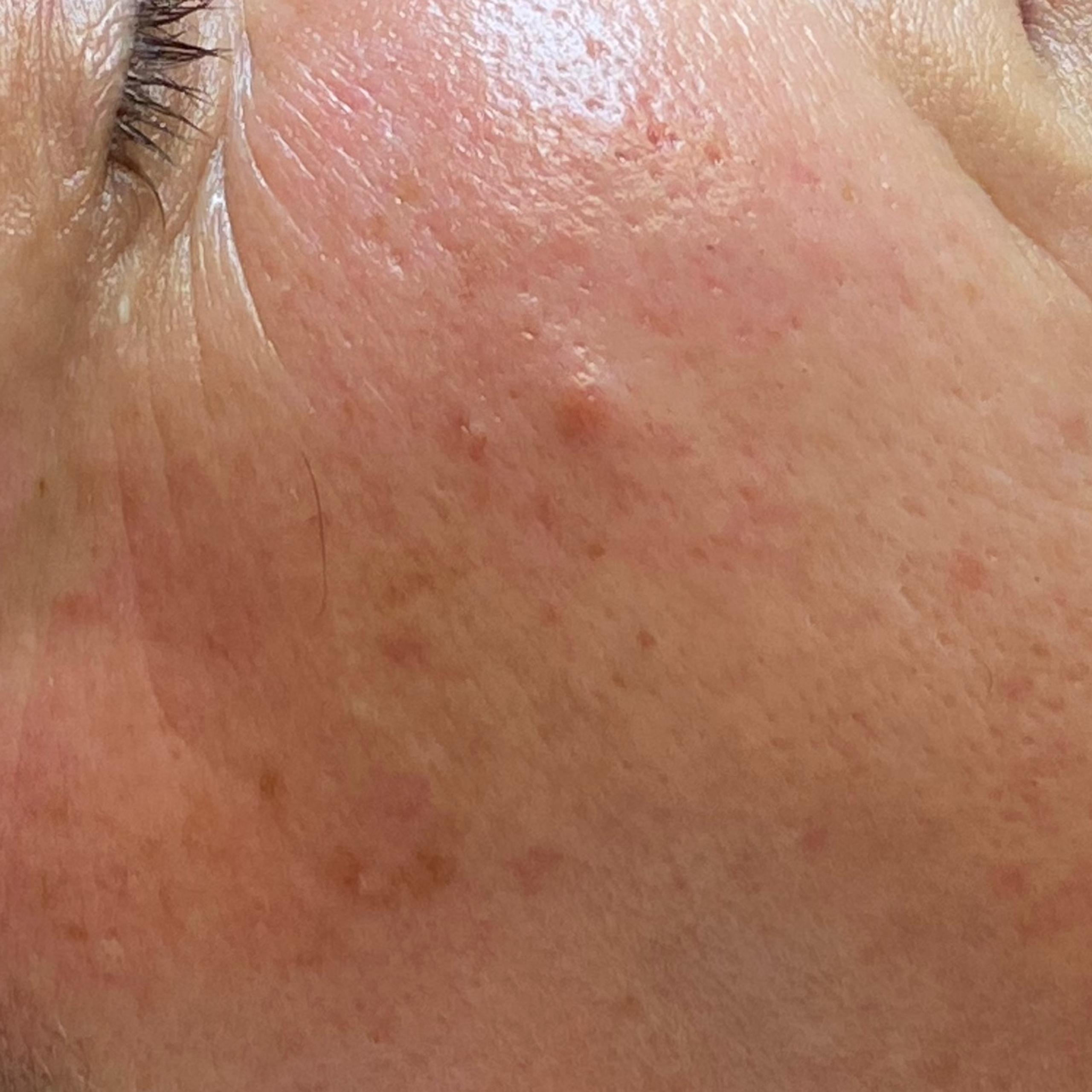 Side profile of a person's face, showing wrinkles around the eye and dark spots on the cheek.