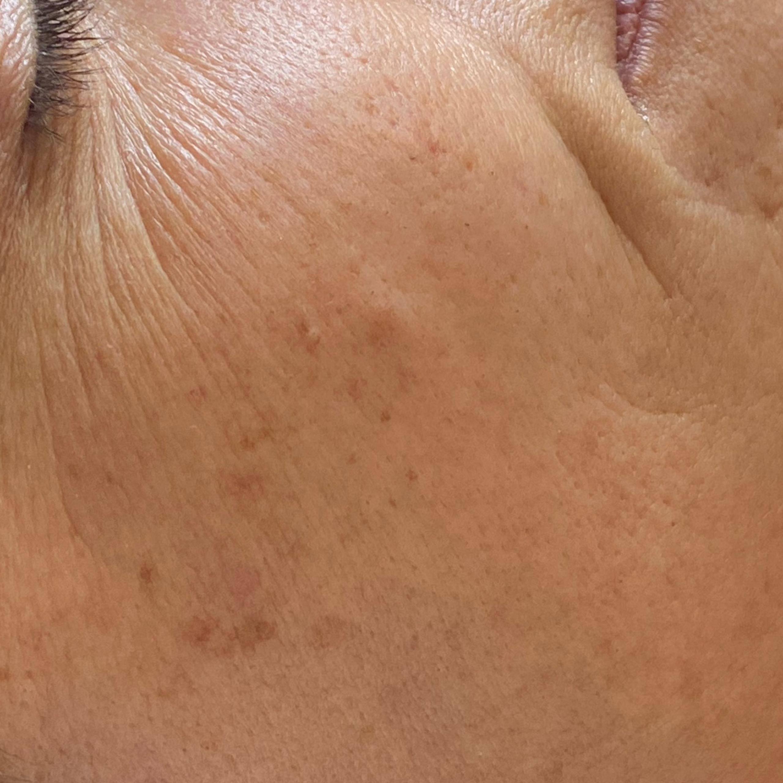 Side profile of a person's face, showing wrinkles around the eye and dark spots on the cheek.