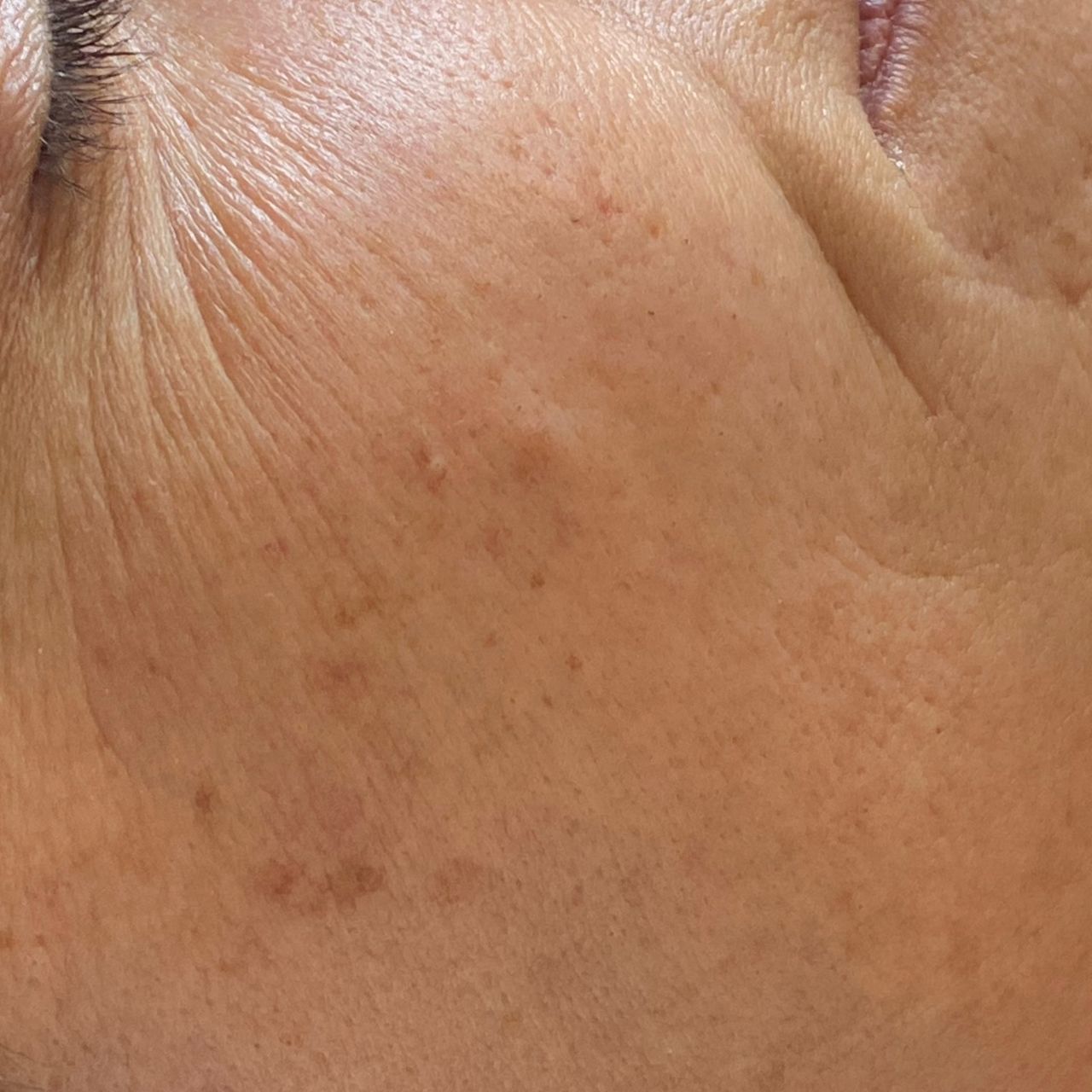 Side profile of a person's face, showing wrinkles around the eye and dark spots on the cheek.