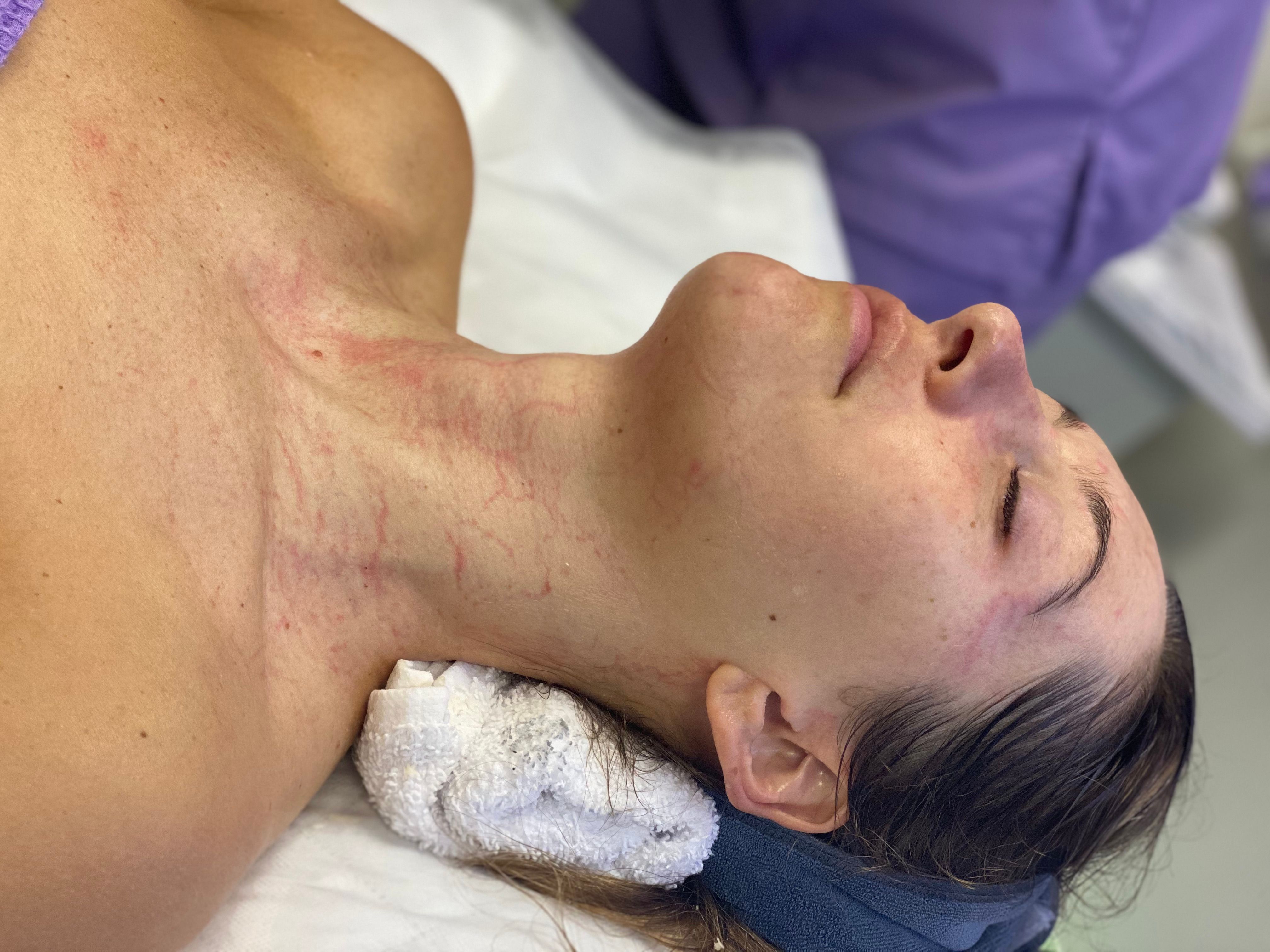 A person with eyes closed, showing red marks on their neck and chest after the facial