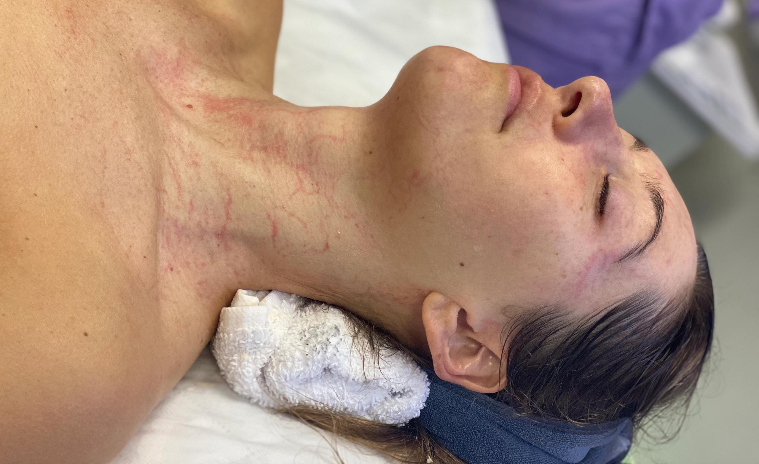 A person with eyes closed, showing red marks on their neck and chest after the facial
