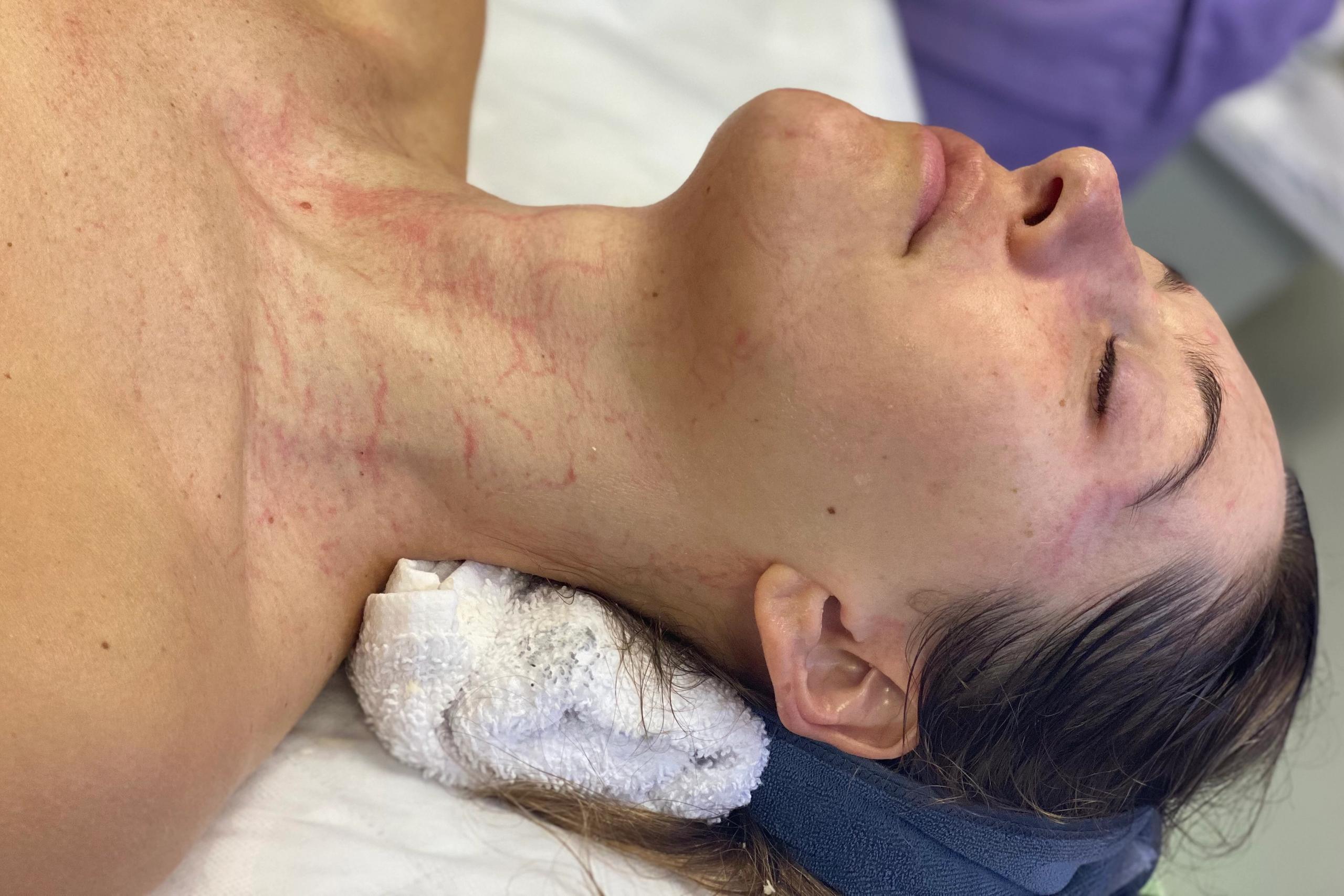 A person with eyes closed, showing red marks on their neck and chest after the facial