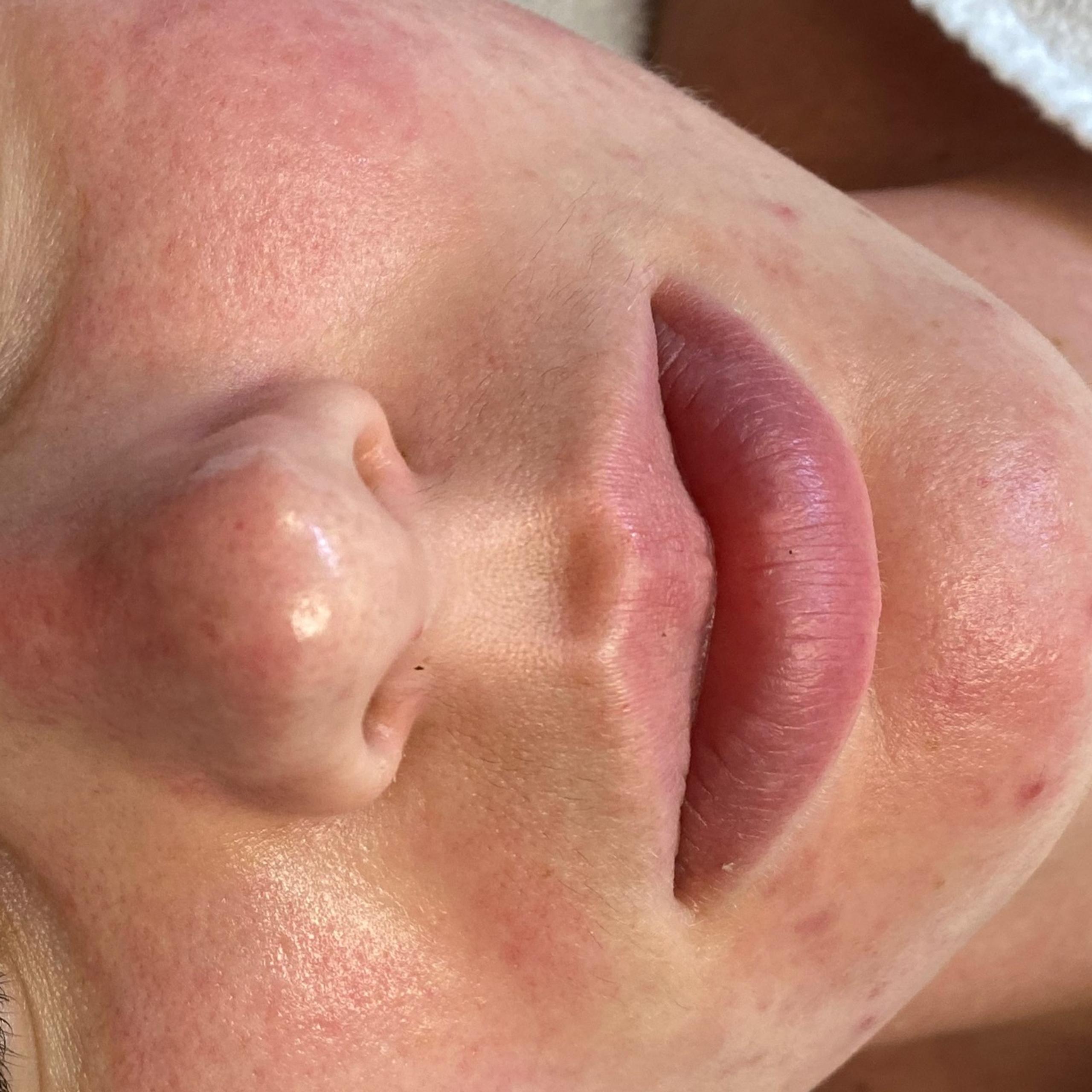 Close-up of a person's face. Skin is red, but clear from acne