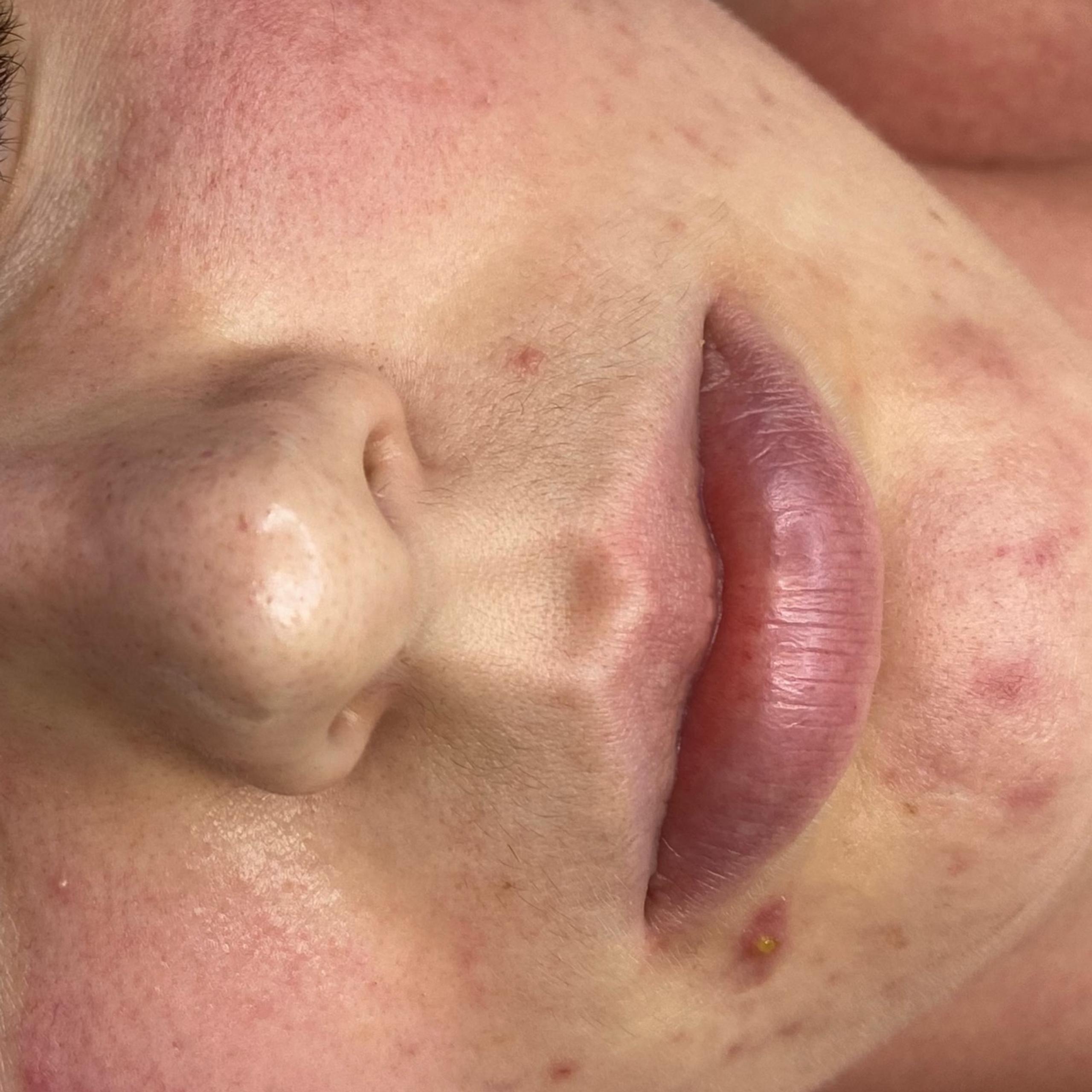 Close-up of a person's face with widespread redness and acne.