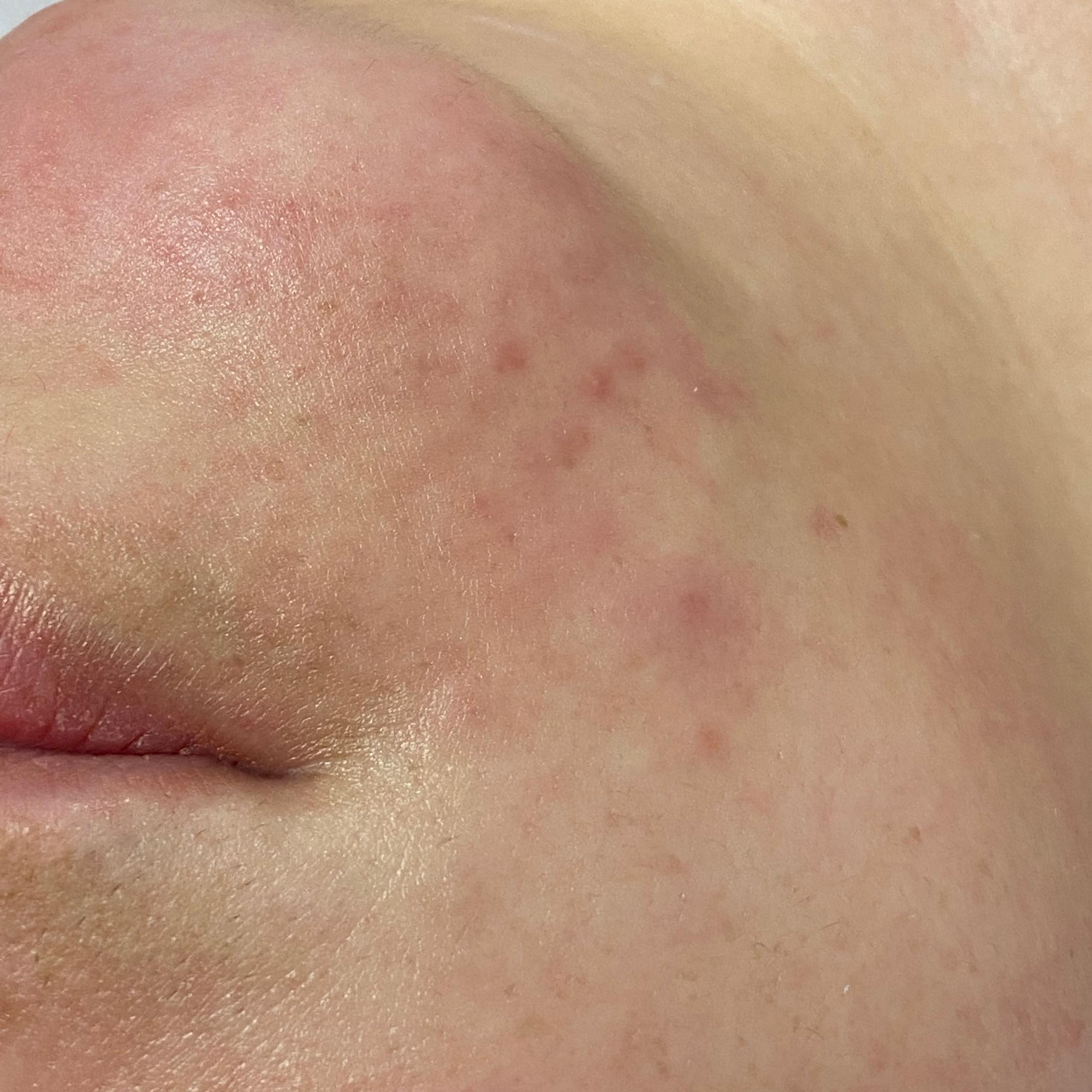 Close-up of skin on chin and lower cheek showing redness but no bumps.