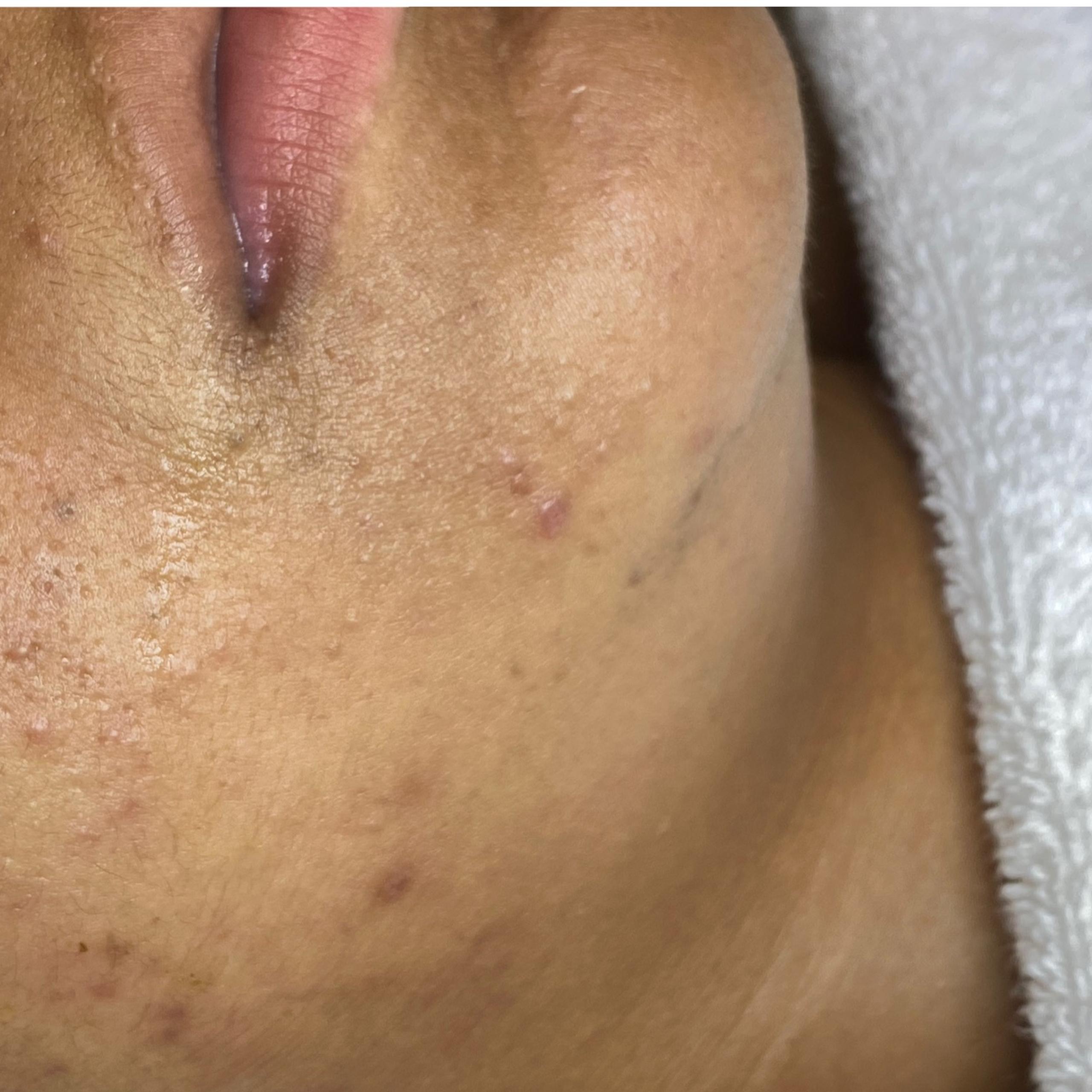 Close-up of skin on a person's cheek and jawline showing acne and visible pores.