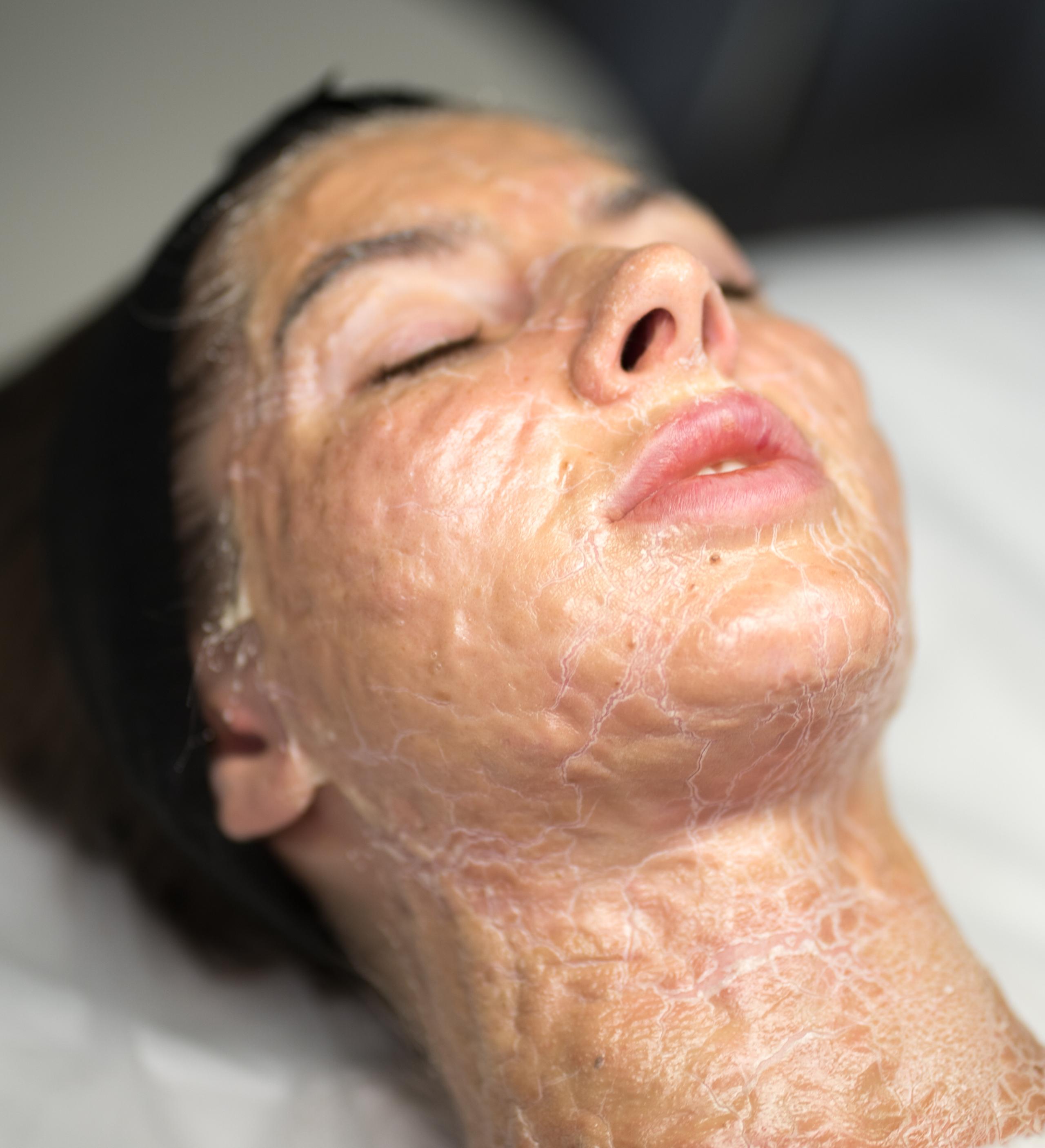 A person's face and neck covered in a dry, cracked layer of skin
