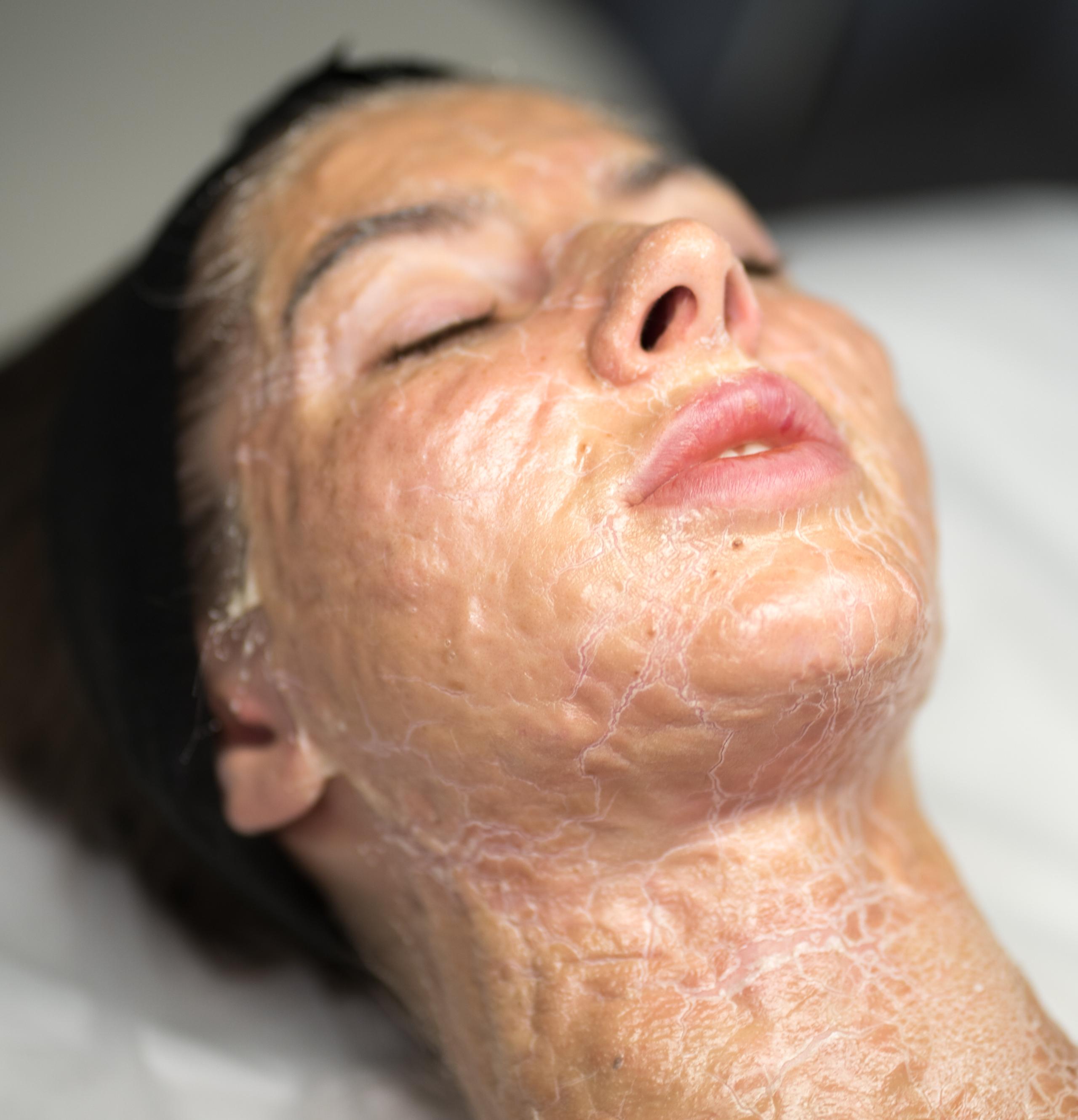 A person's face and neck covered in a dry, cracked layer of skin