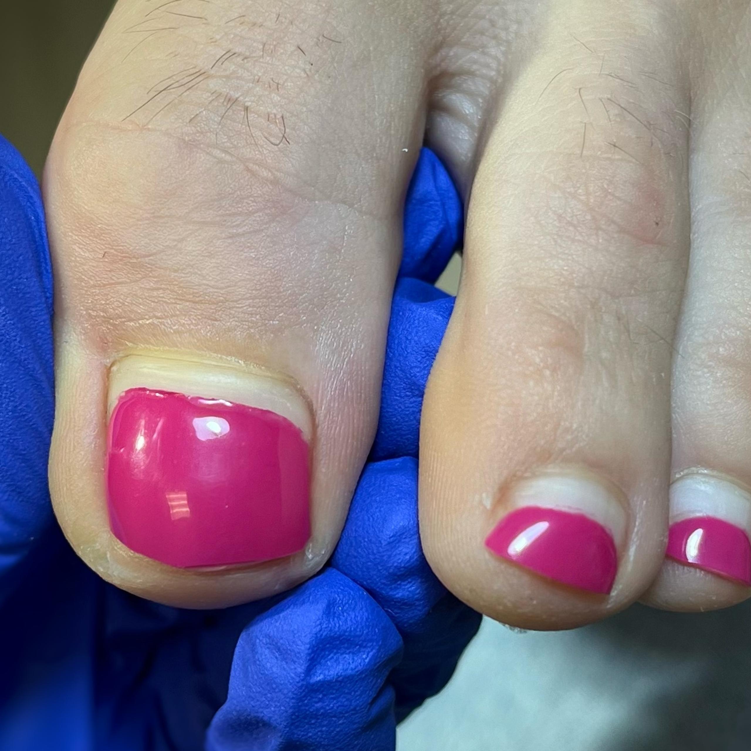 Toes with hot pink French tip nail polish, held by a blue gloved hand.