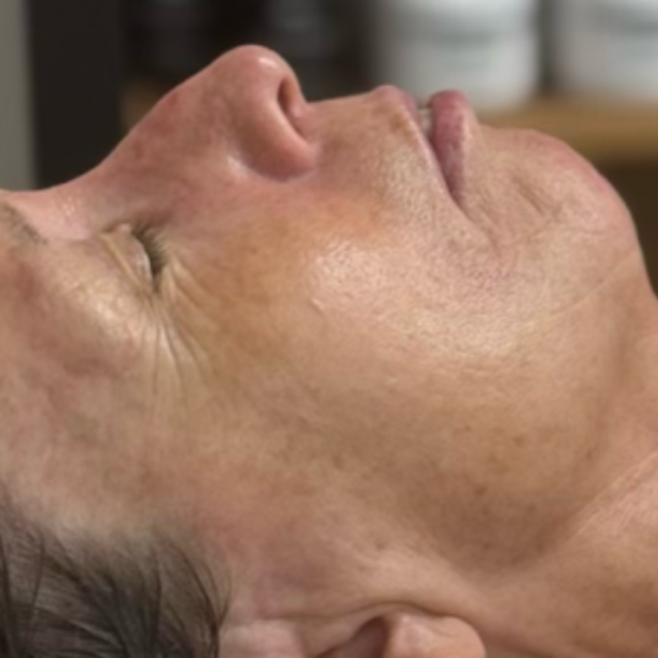 a woman's face, showing a reduction in wrinkles around the eyes and mouth