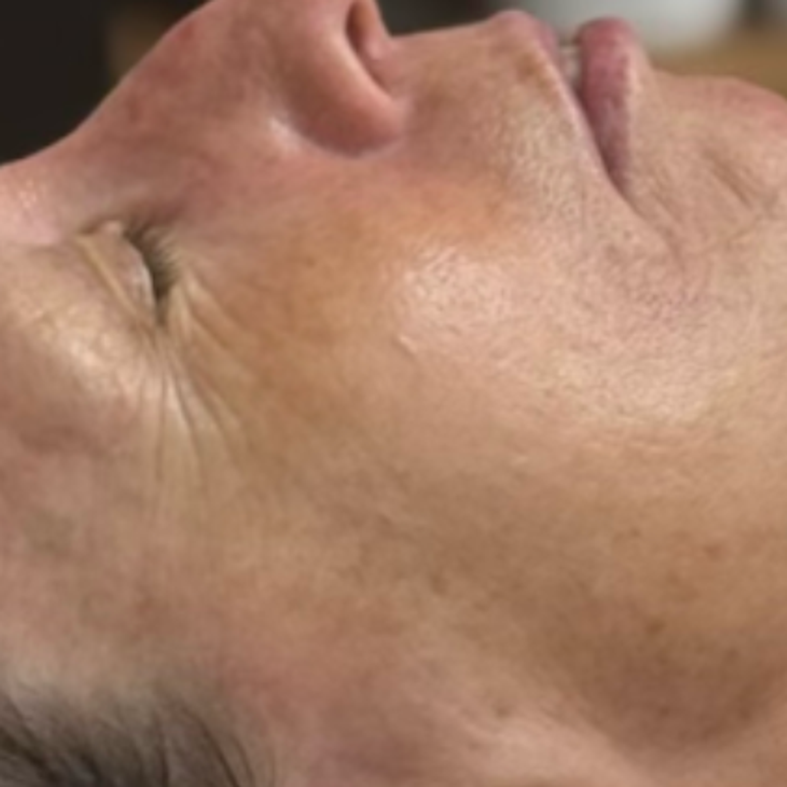 a woman's face, showing a reduction in wrinkles around the eyes and mouth