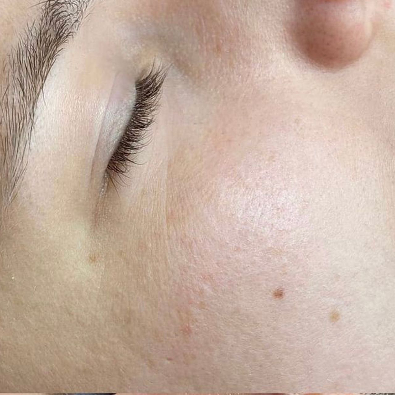 Close-up of a person's face with closed eyes and dry skin flaky skin.