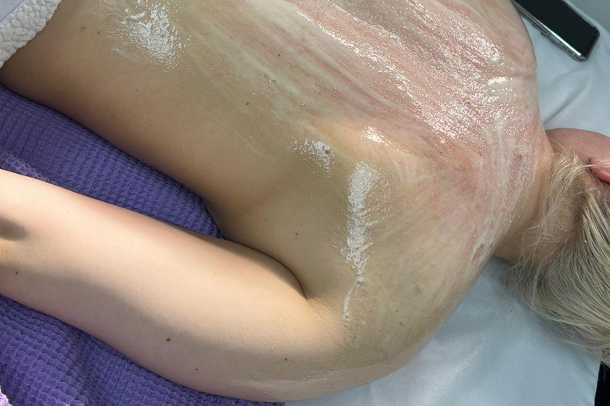 A person lies face down with a creamy white and pink treatment on their bare back.