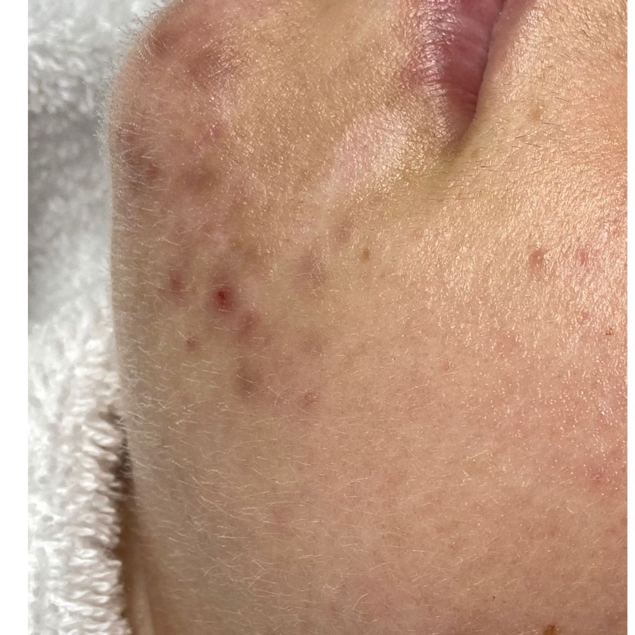 Close-up of a chin and lower lip with acne blemishes and fine facial hair.