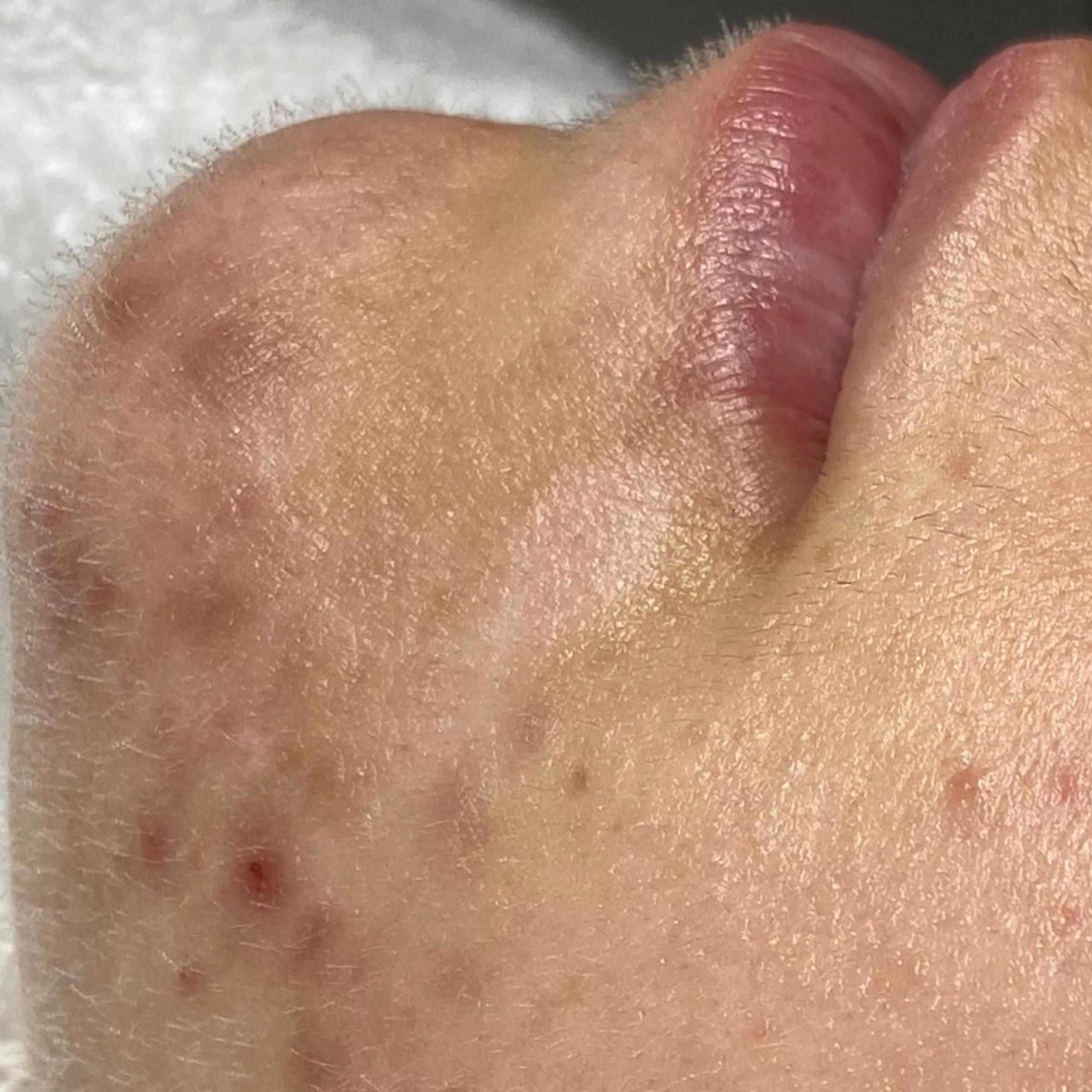 Close-up of a chin and lower lip with acne blemishes and fine facial hair.