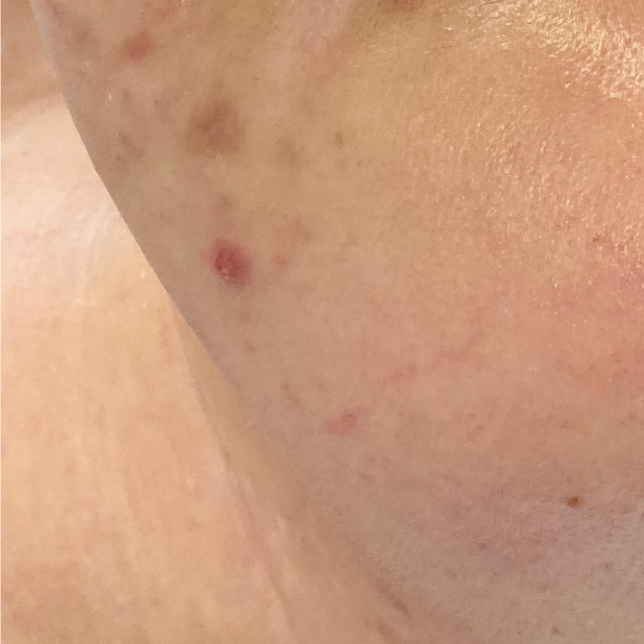 Close-up of a chin and neck with less visible acne and blemishes and no hair