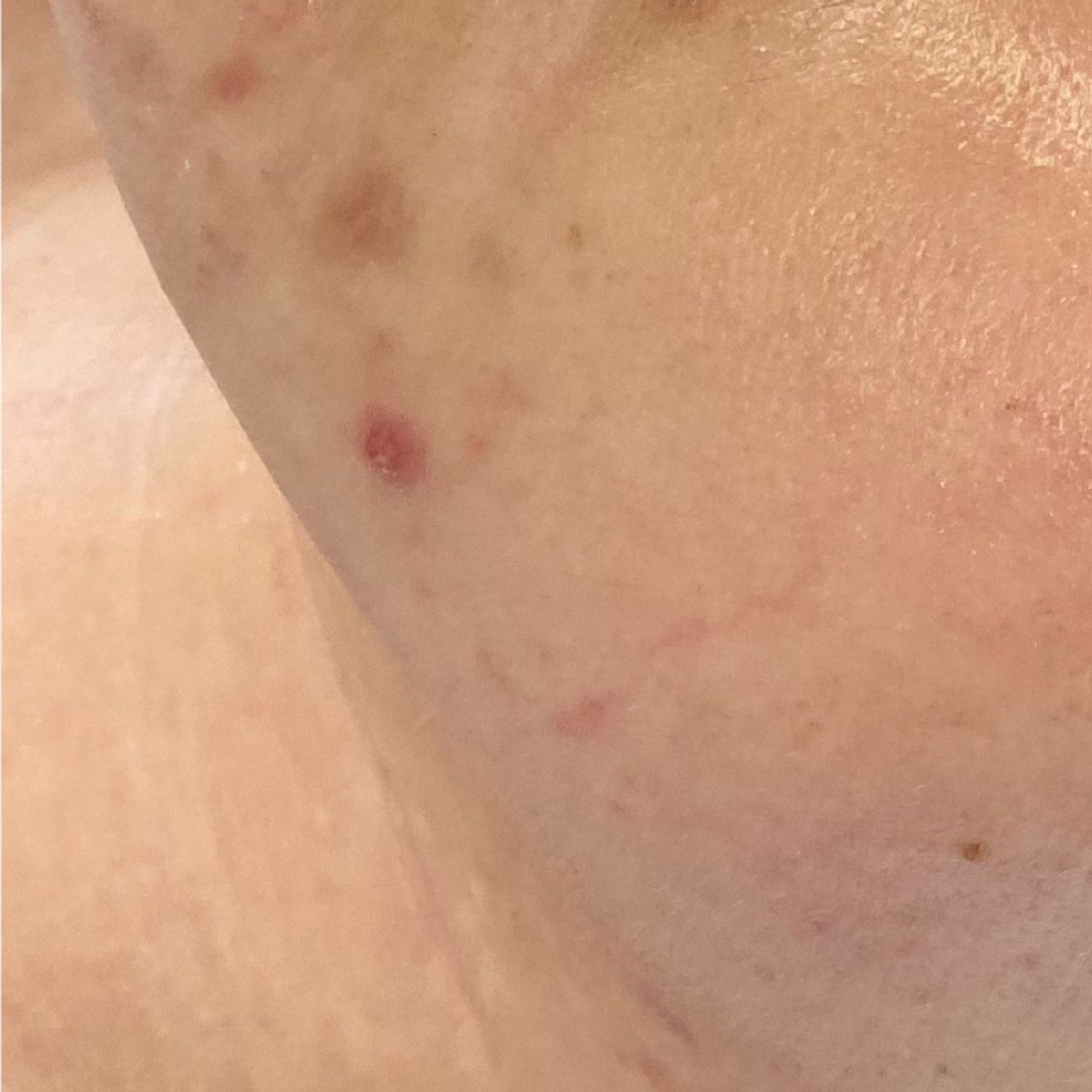 Close-up of a chin and neck with less visible acne and blemishes and no hair