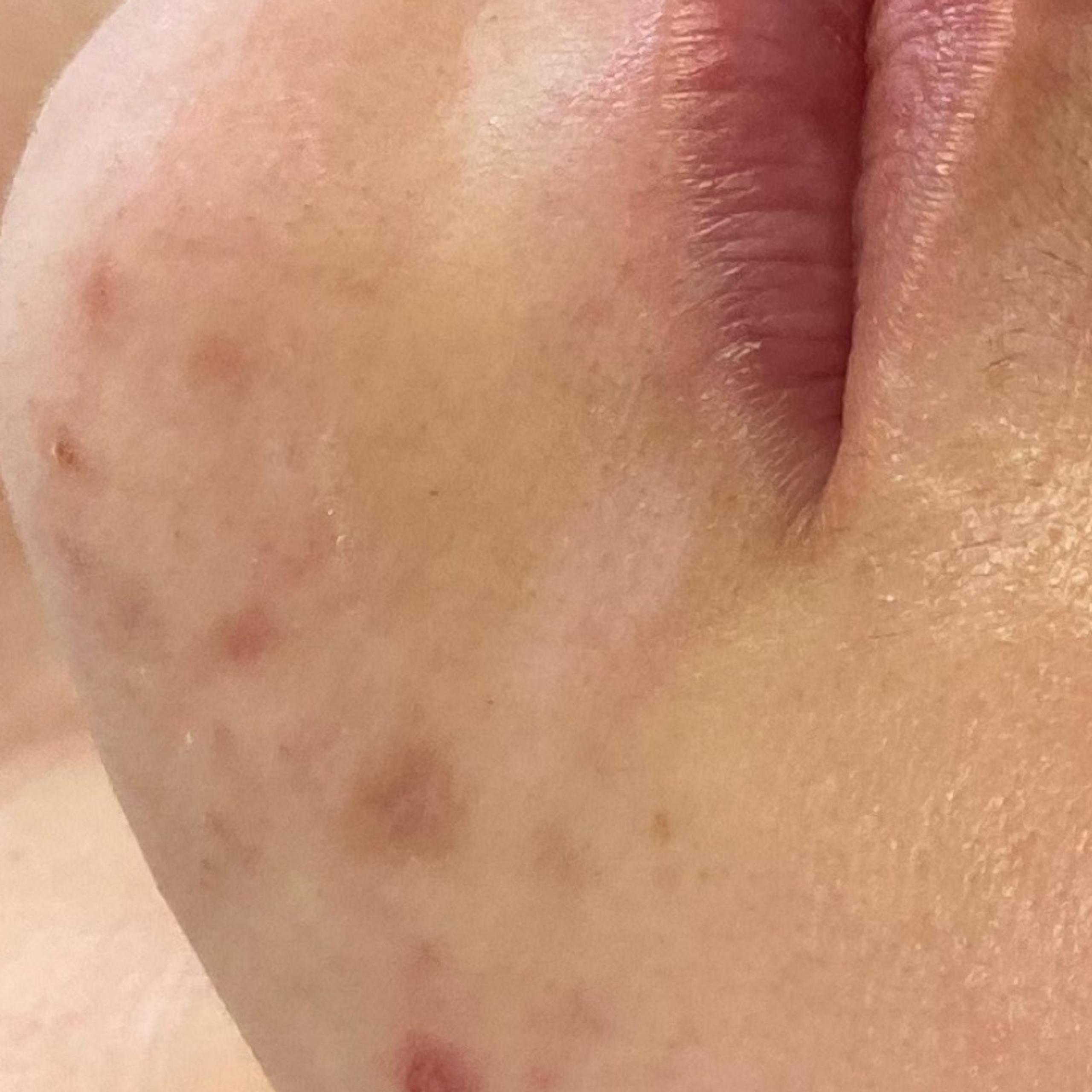 Close-up of a chin and neck with less visible acne and blemishes and no hair