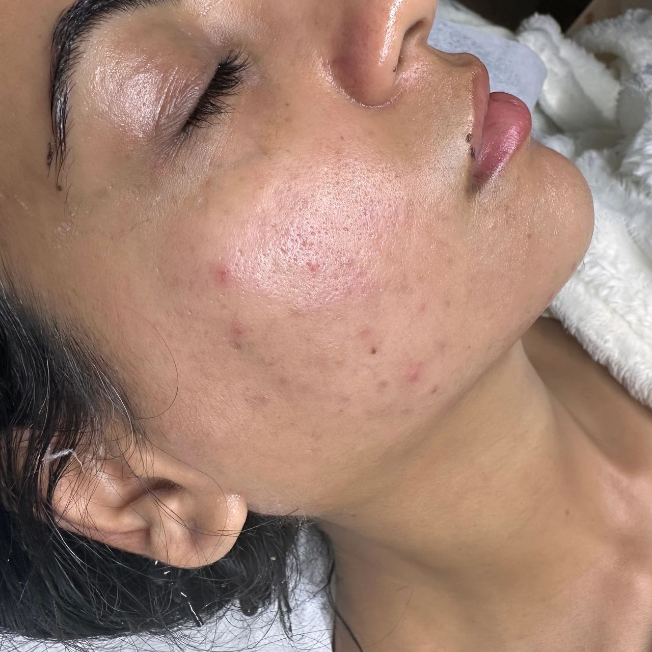 Close-up of a person's face with closed eyes and barely visible acne on the cheek and jawline.