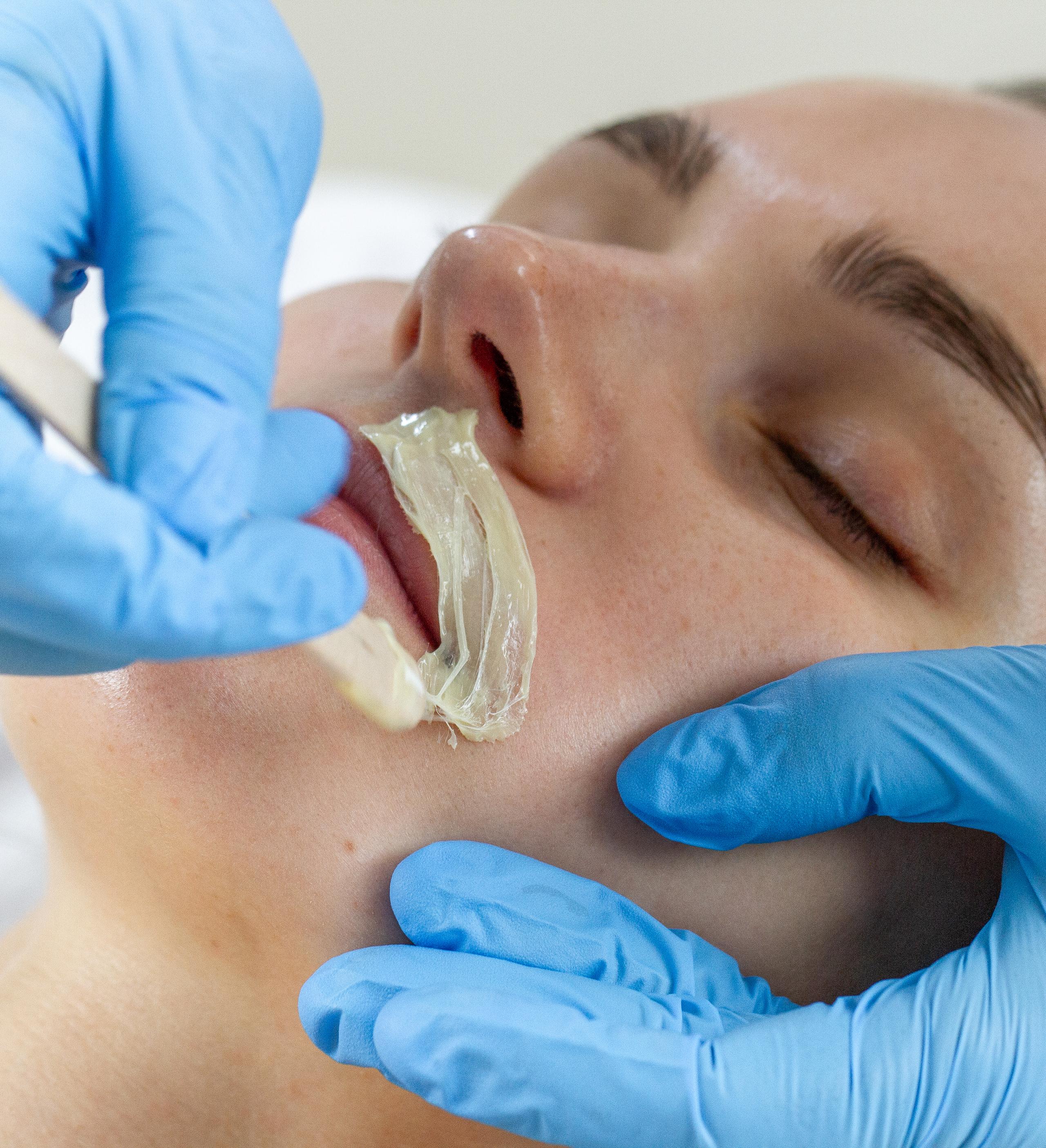 Woman getting upper lip waxed by gloved hands.