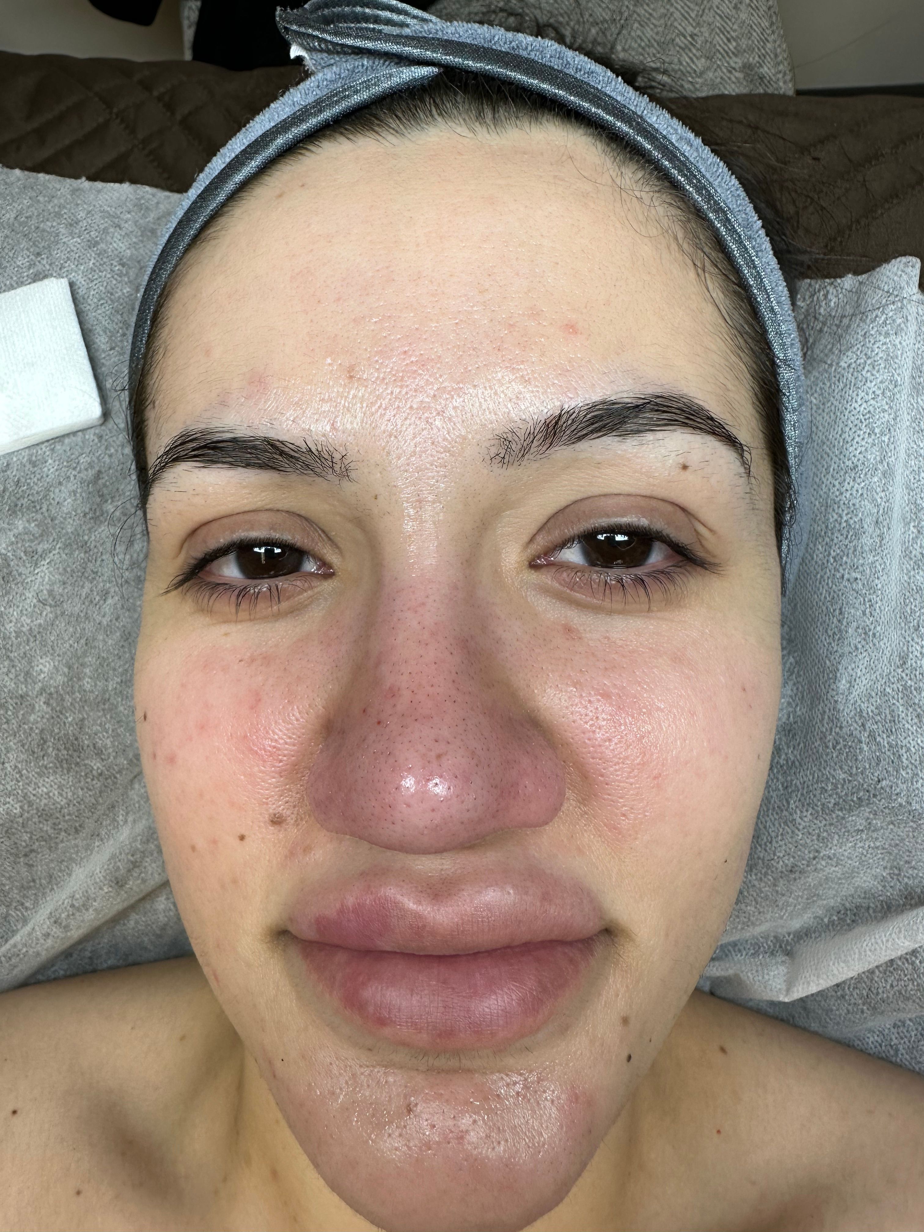 Right eye with straight, downward-pointing lashes before treatment.