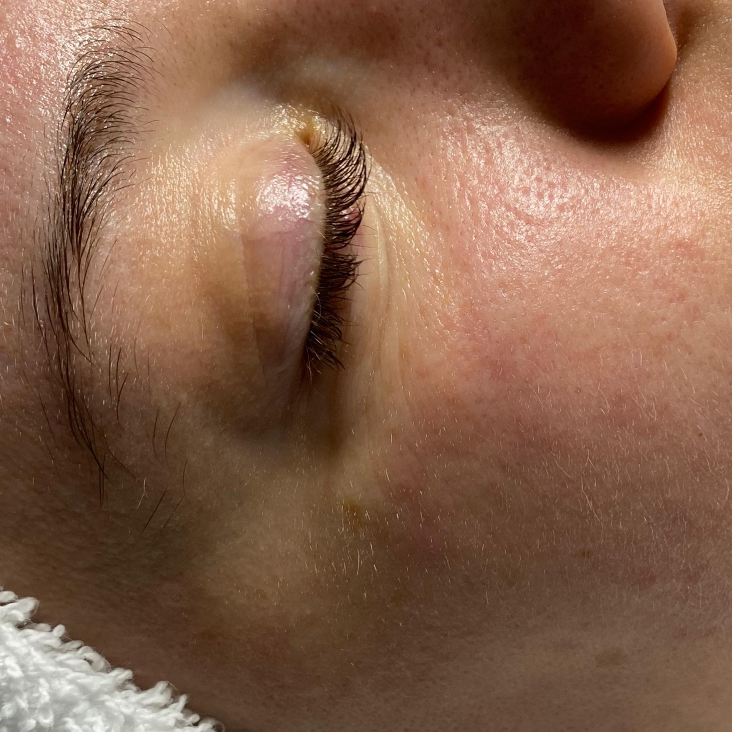 Close-up of a person's face with a closed eye, showing some blemishes on the cheek