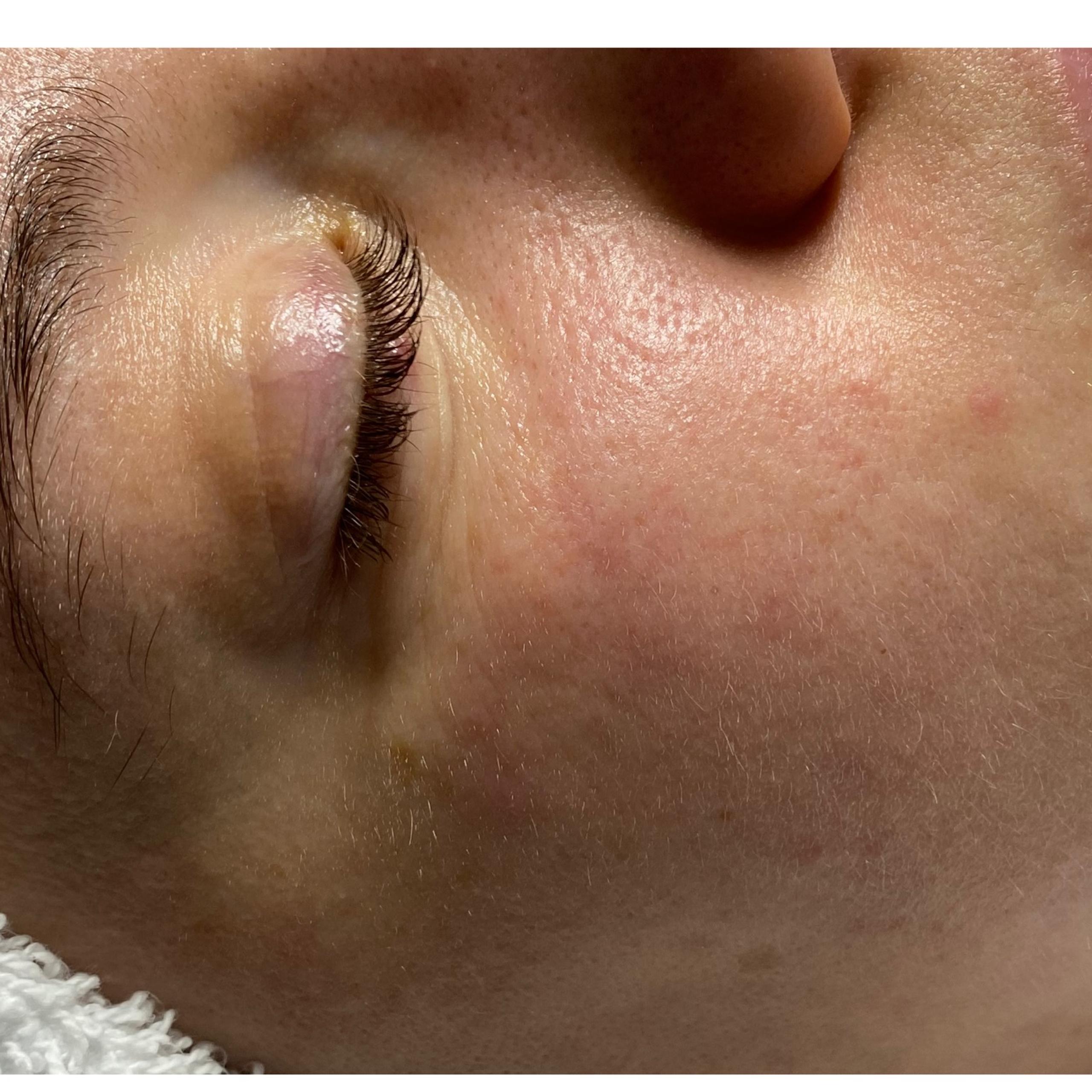 Close-up of a person's face with a closed eye, showing some blemishes on the cheek