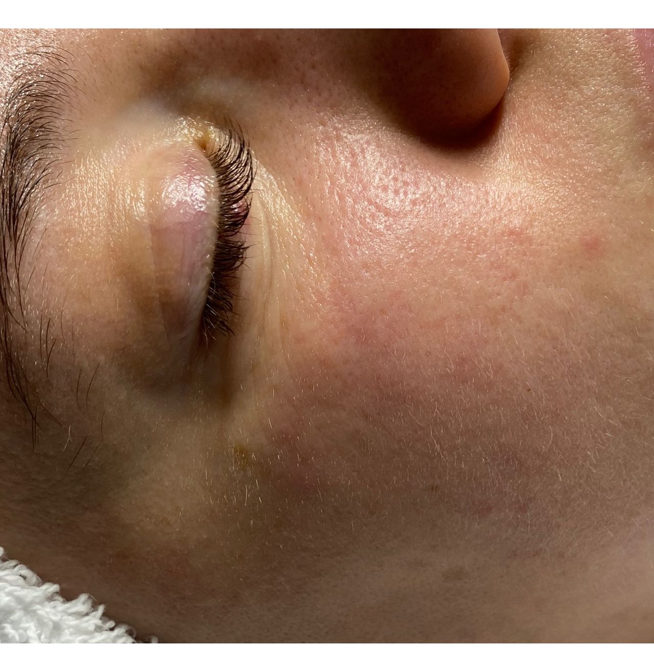 Close-up of a person's face with a closed eye, showing some blemishes on the cheek