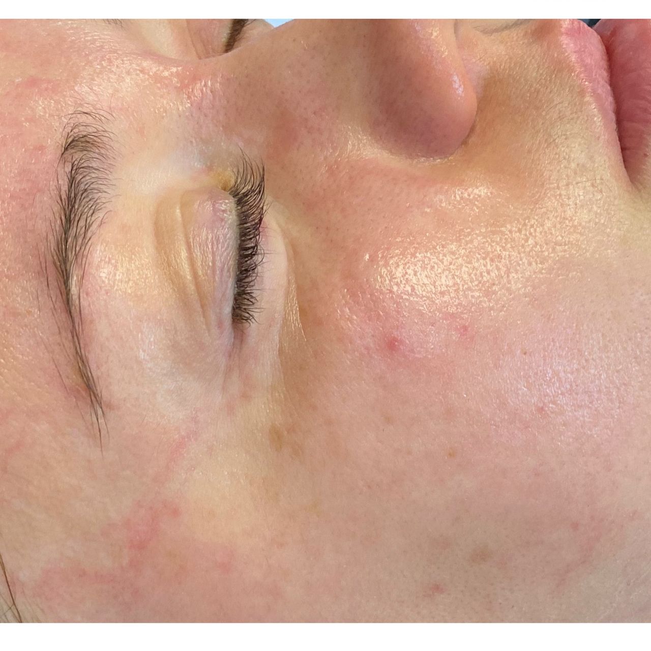 Close-up of a person's face with closed eyes, showing skin with redness and post acne inflammation.