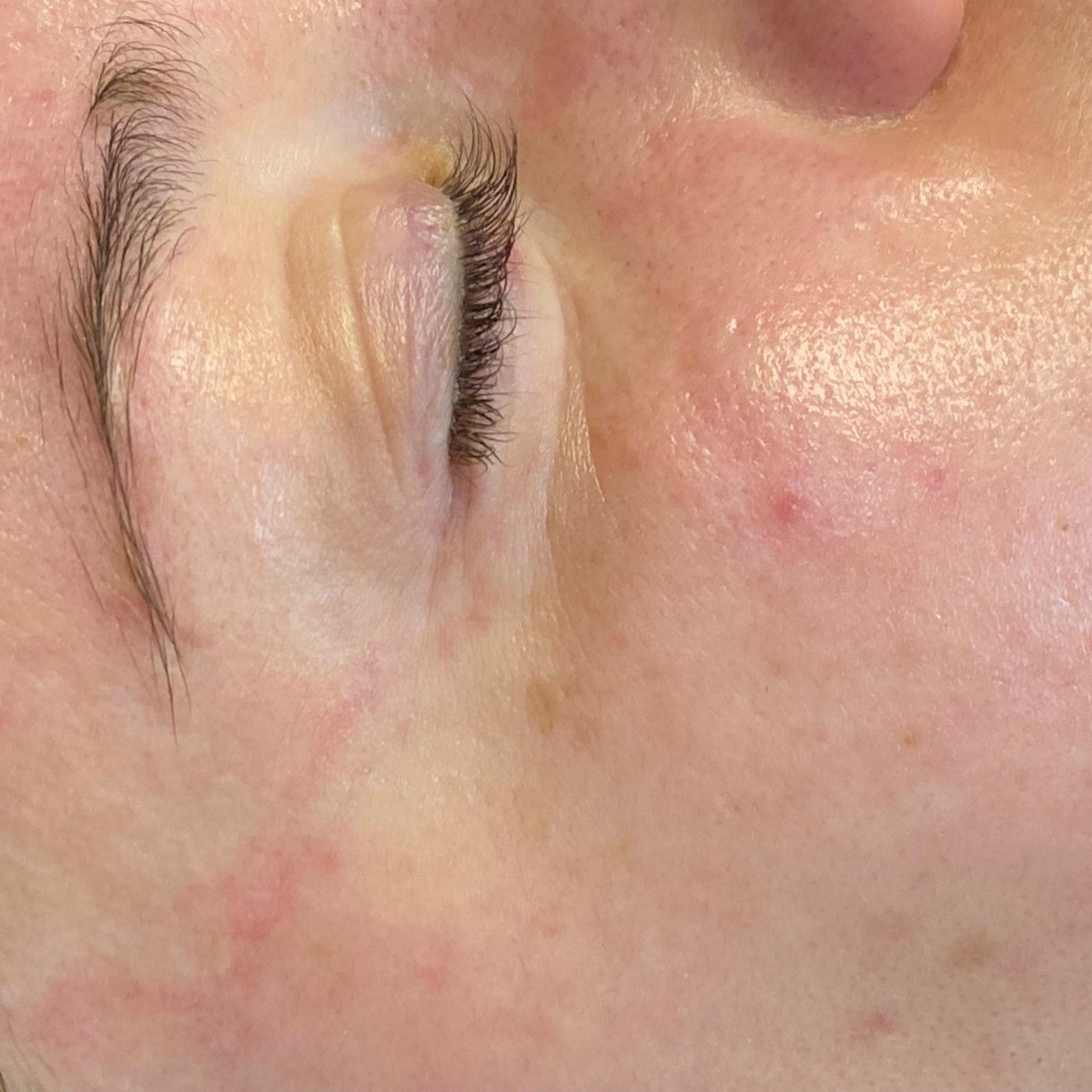 Close-up of a person's face with closed eyes, showing skin with redness and post acne inflammation.