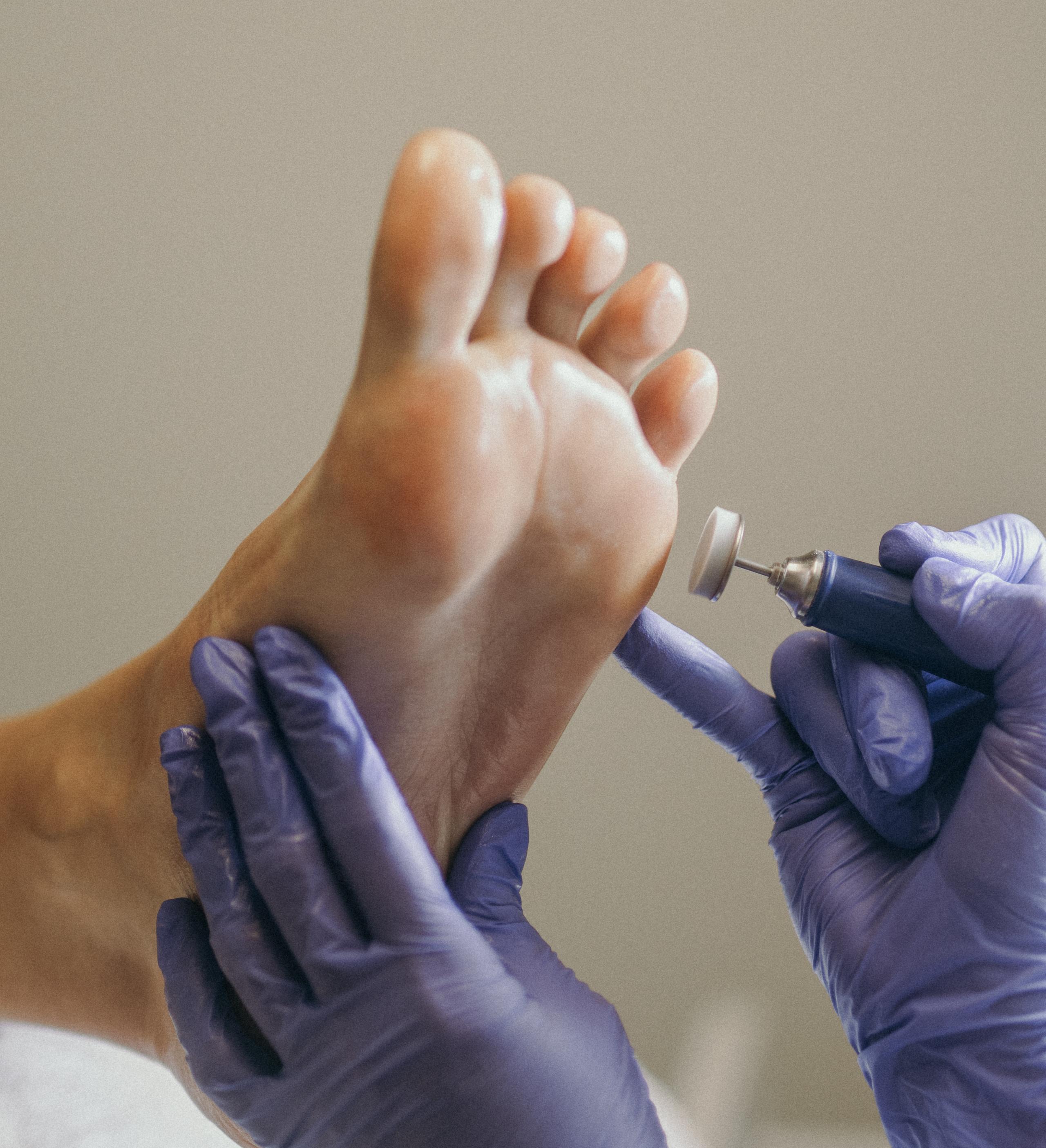 A gloved hand uses an electric file on the sole of a bare foot.