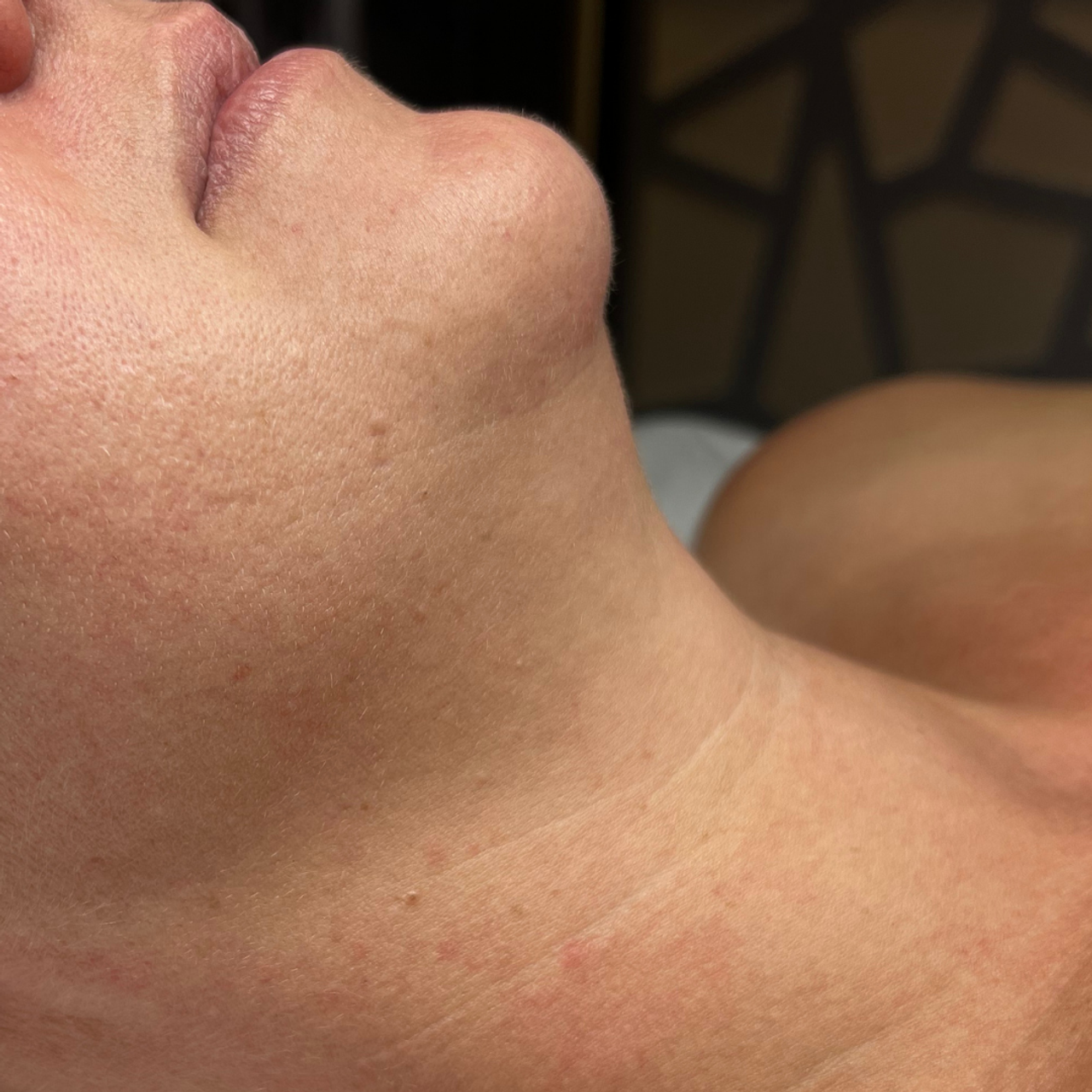 Side profile of a person's lower face and neck showing a double chin, labeled "BEFORE".