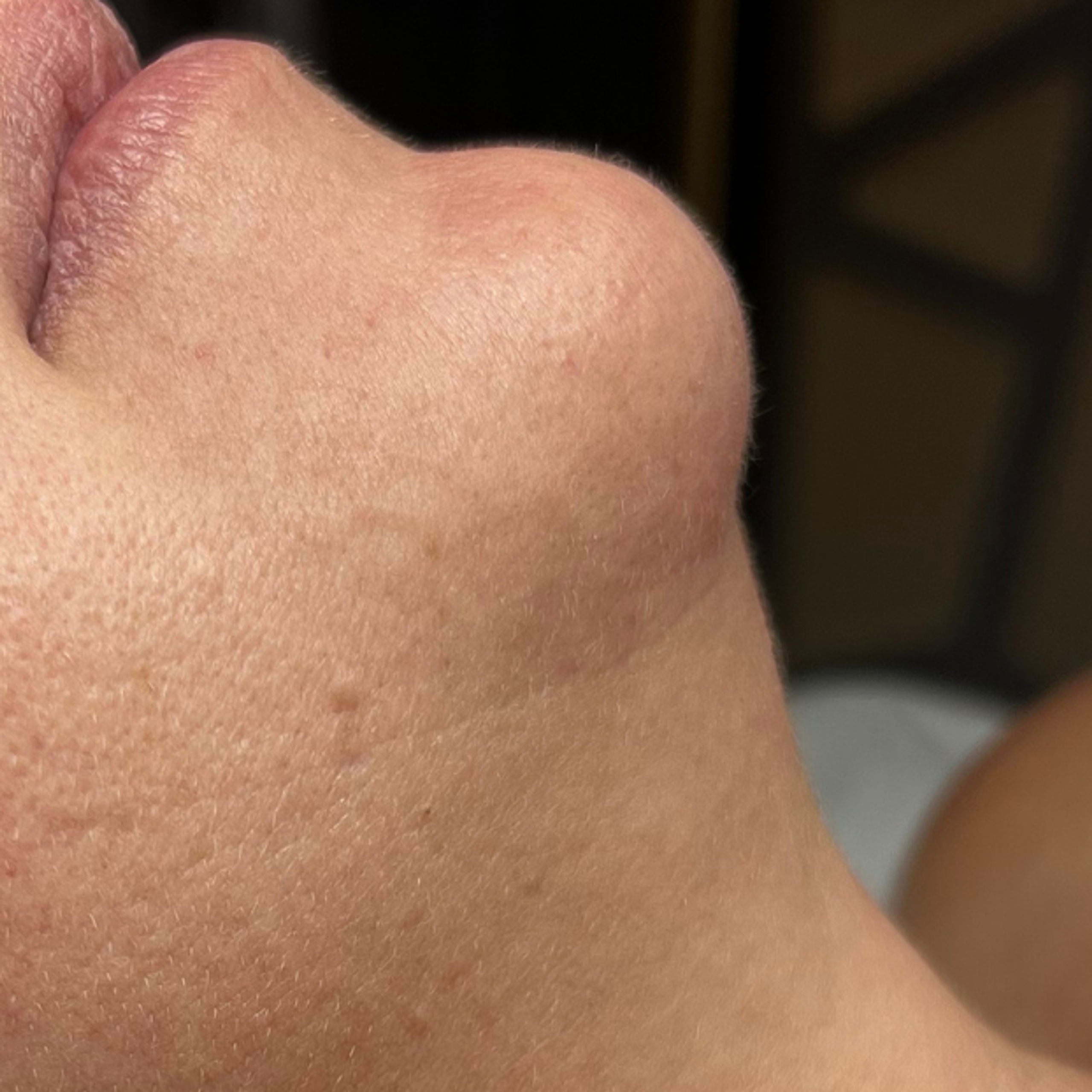 Side profile of a person's lower face and neck showing a double chin, labeled "BEFORE".